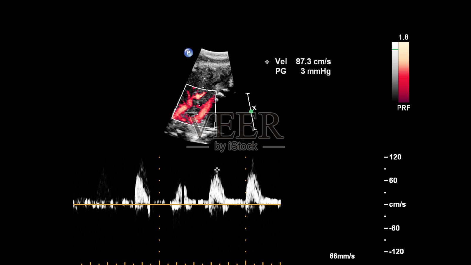 超声筛查胎儿超声心动图。照片摄影图片