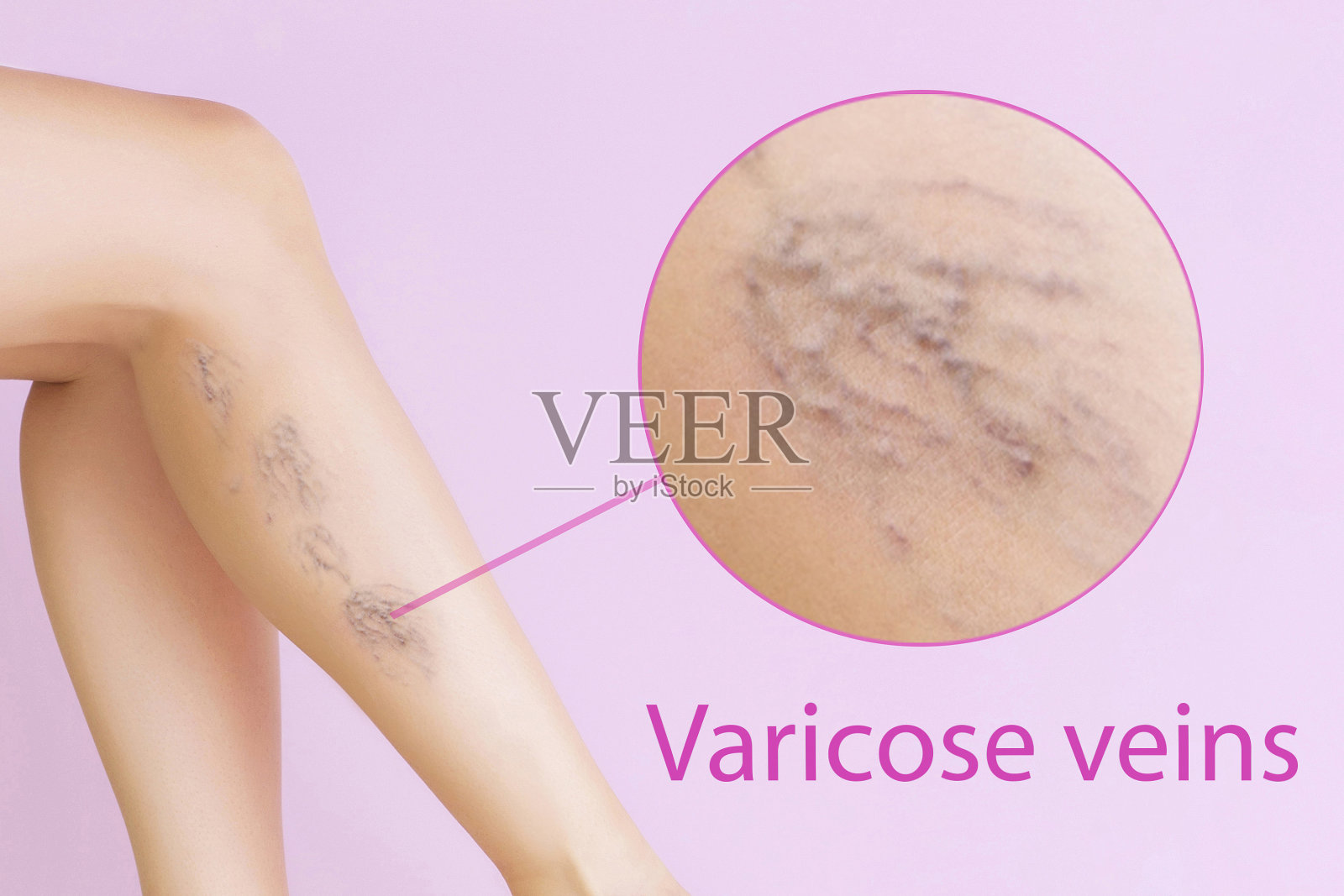 有静脉曲张的女人腿部。人类健康和疾病概念照片摄影图片