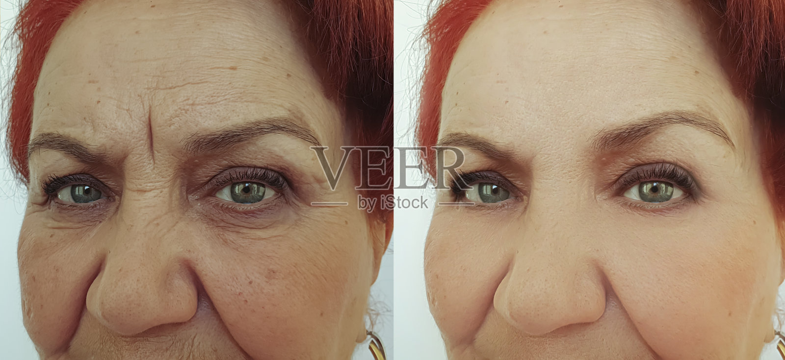 治疗前后皱纹对比照片摄影图片