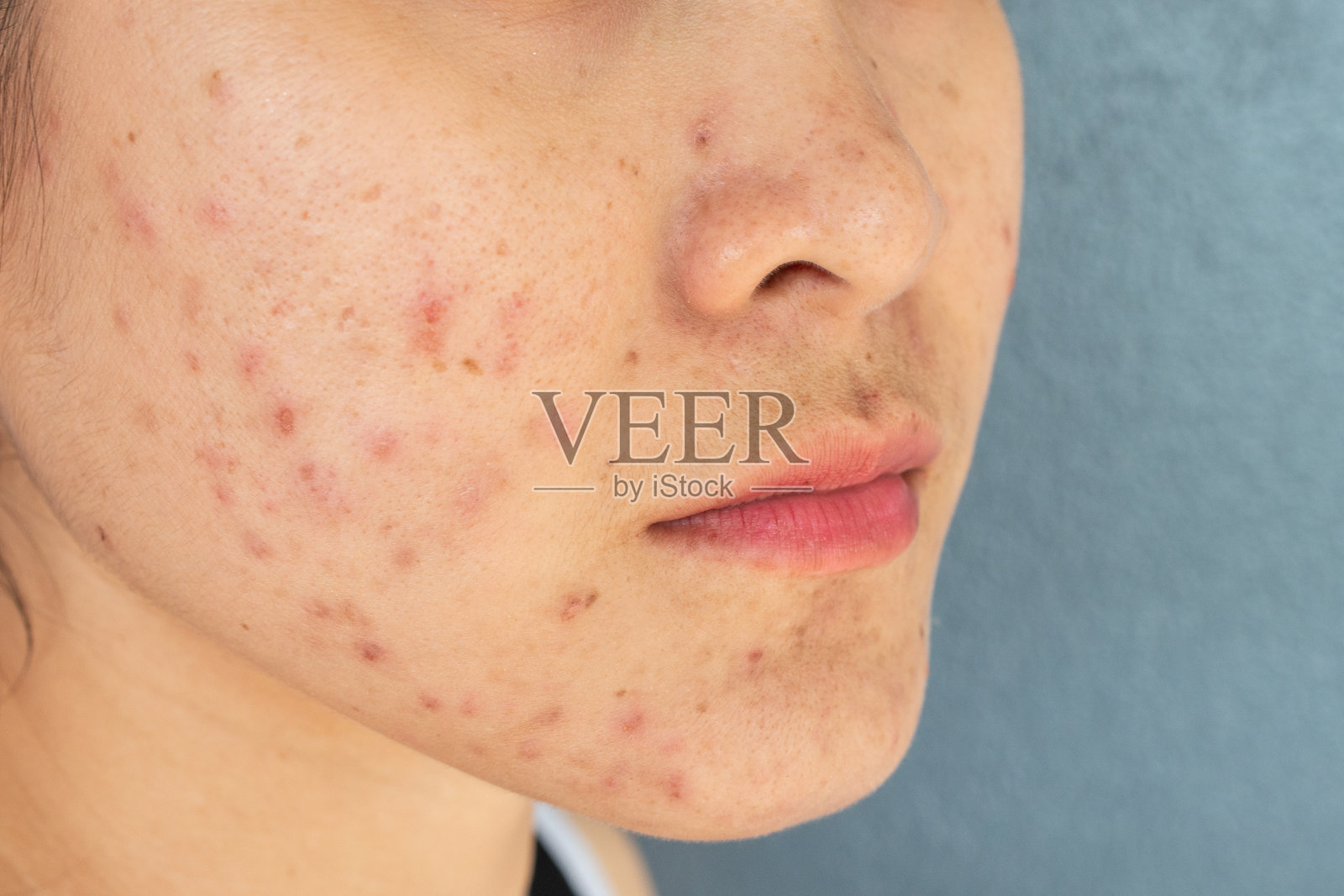 面部有痤疮炎症（丘疹和脓疱）的女人半张脸特写照片摄影图片