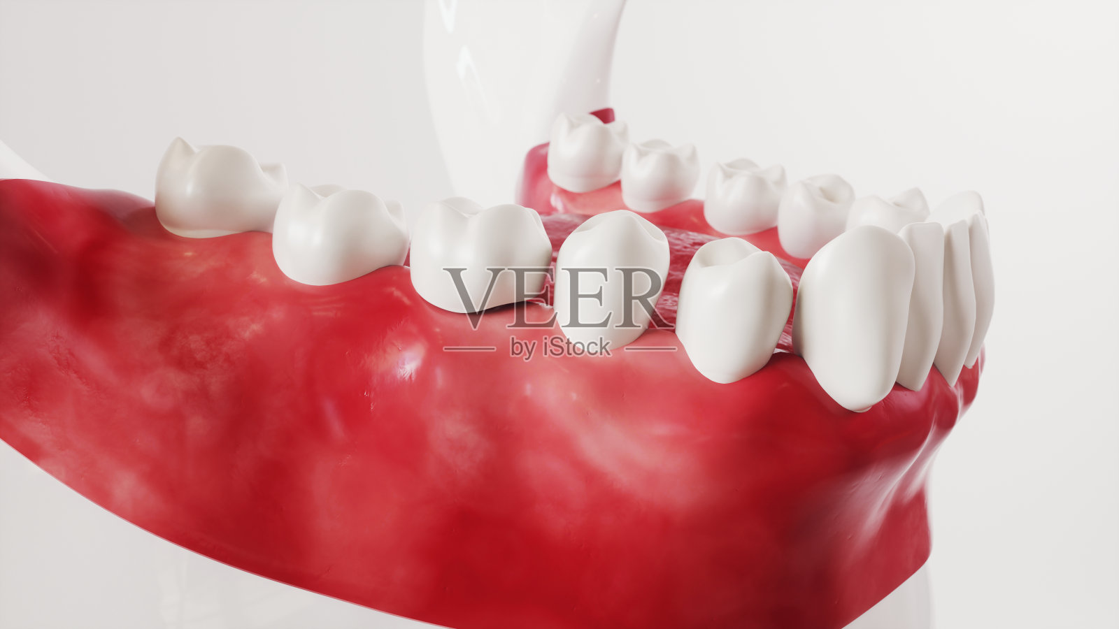 牙种植图片系列13 13 - 3D渲染照片摄影图片