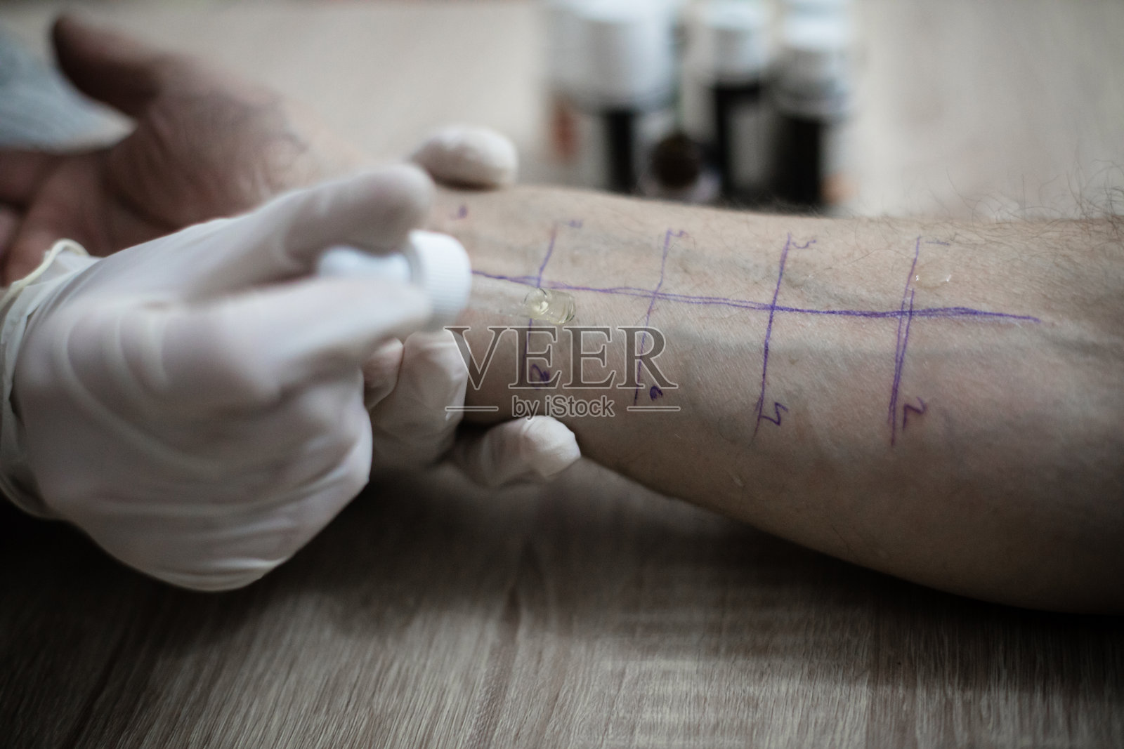 皮肤点刺过敏试验，用于确定过敏类型照片摄影图片