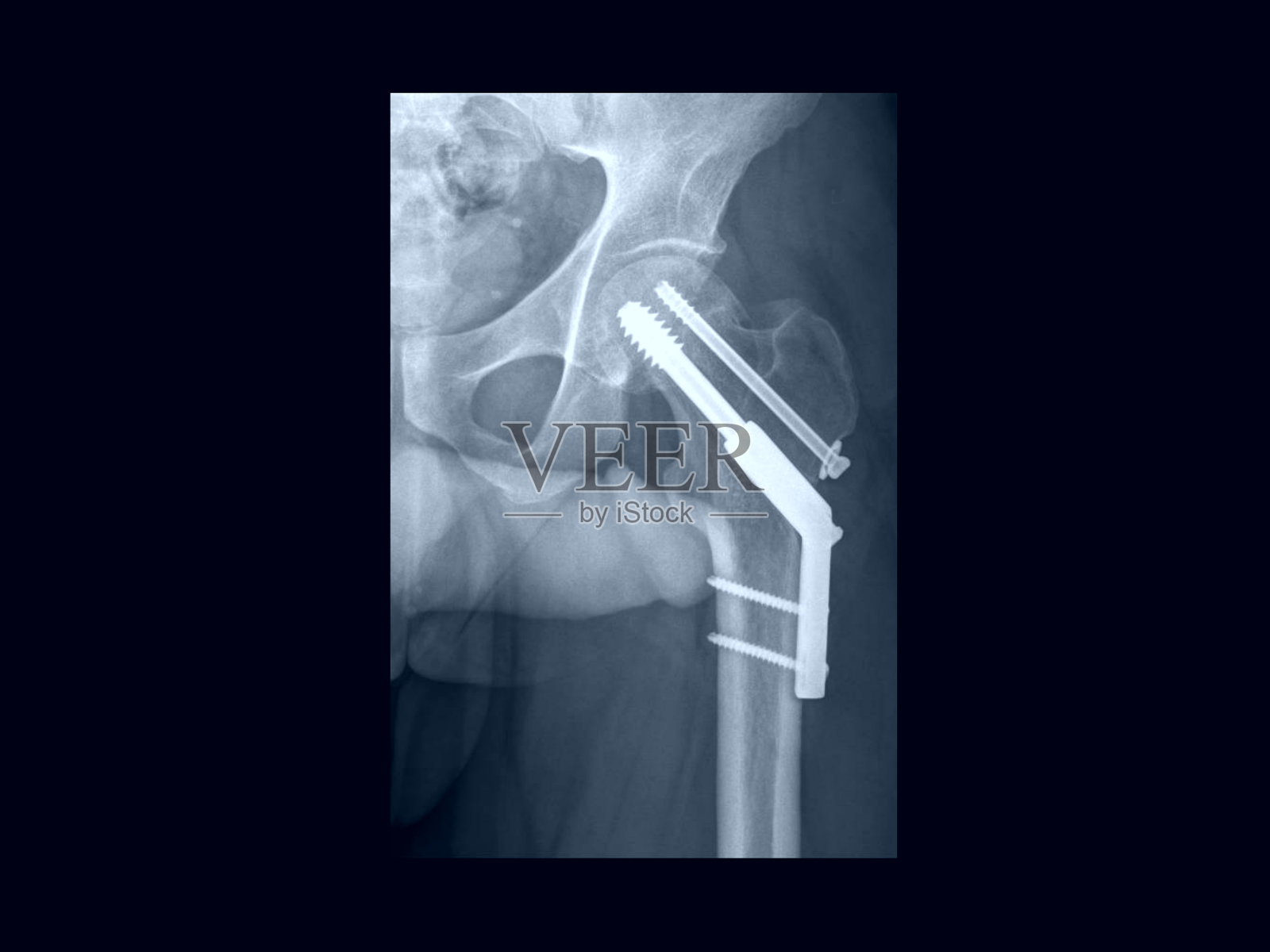 髋部X线片显示动态髋螺钉(DHS)或滑动螺钉固定后股骨骨折。这种骨科植入物用于治疗股骨粗隆间骨折。照片摄影图片