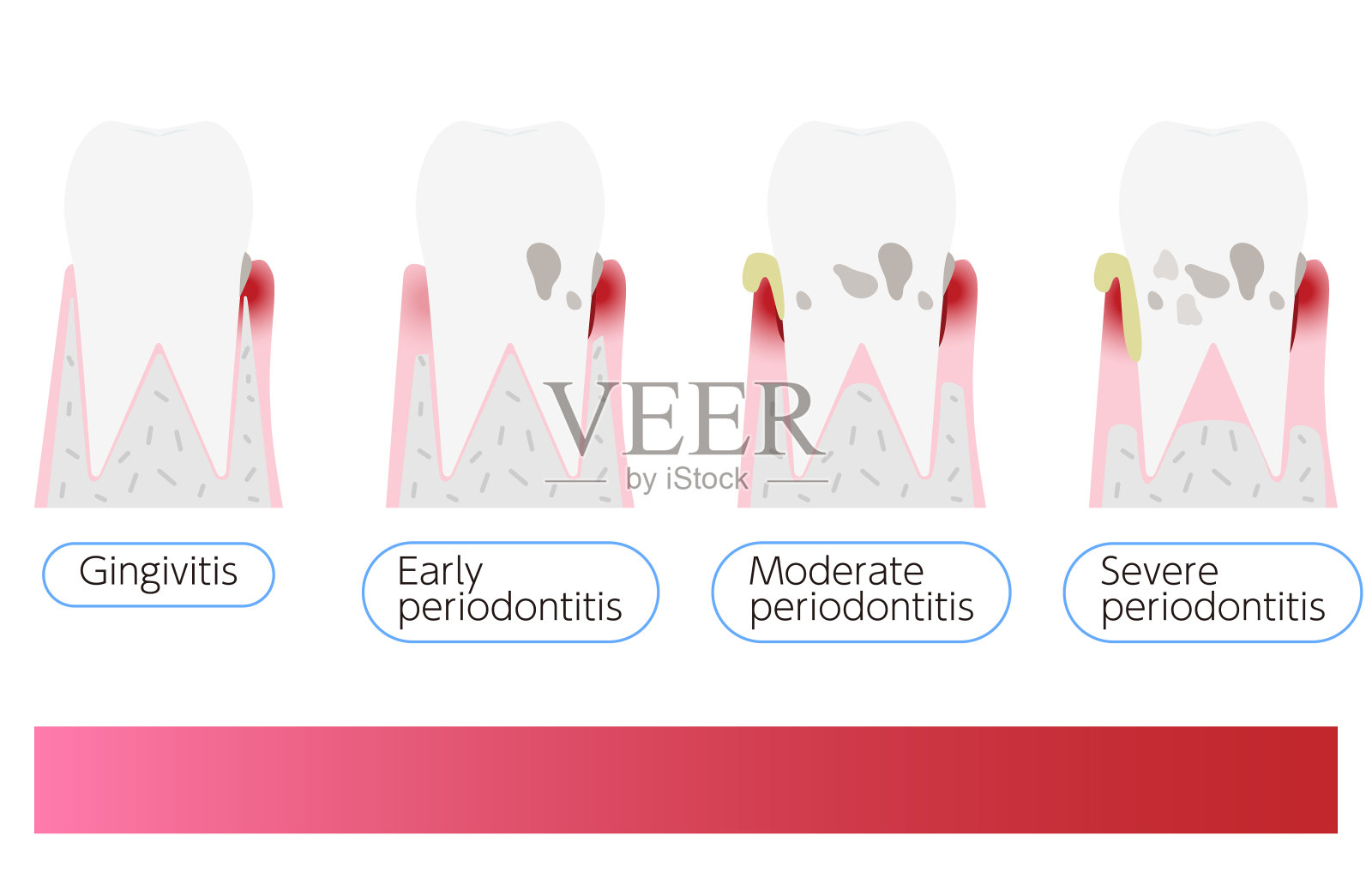 牙周病分期说明:进展顺序插画图片素材