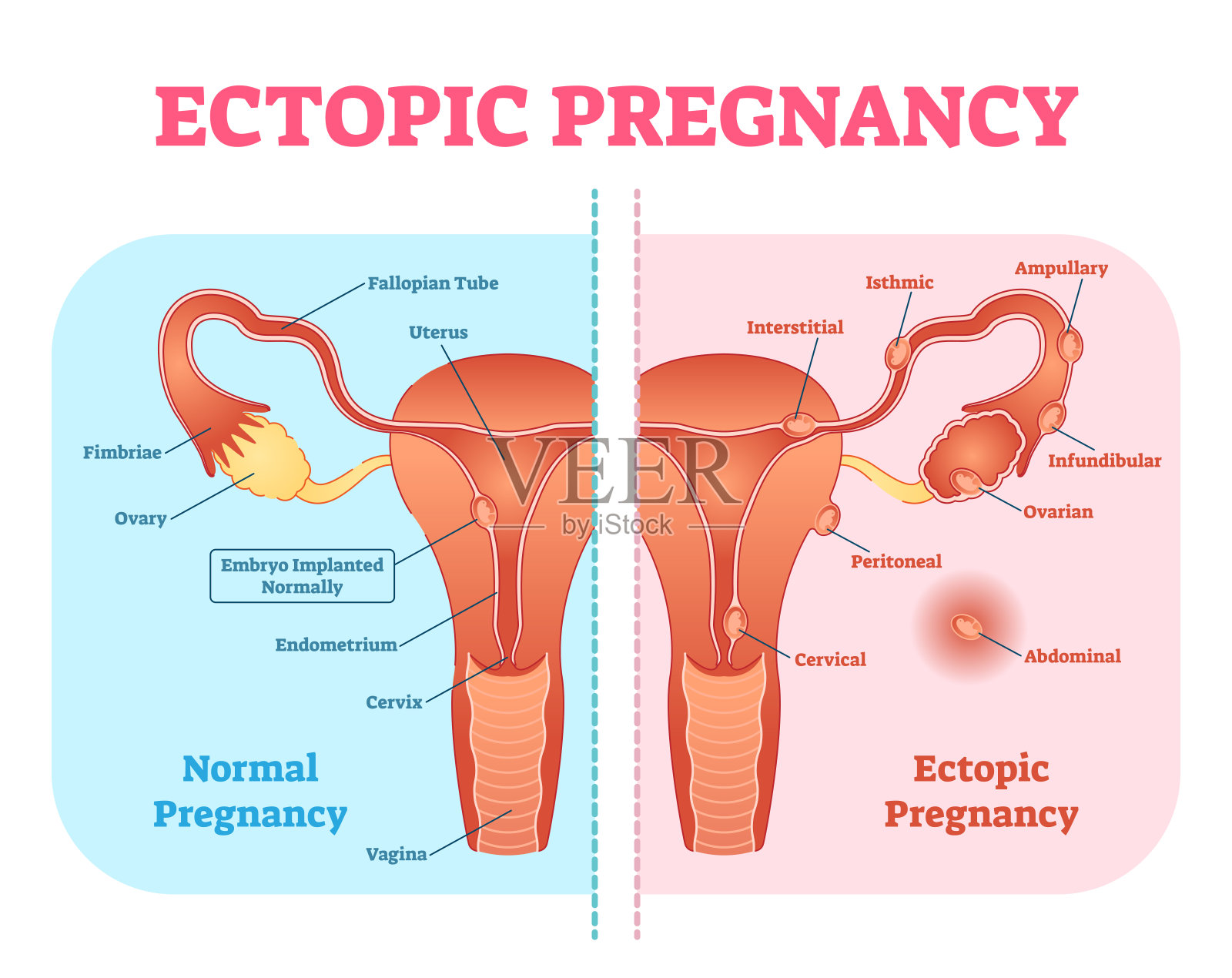 异位妊娠或输卵管妊娠有女性生殖系统和各种胚胎附着位置的医学图。插画图片素材
