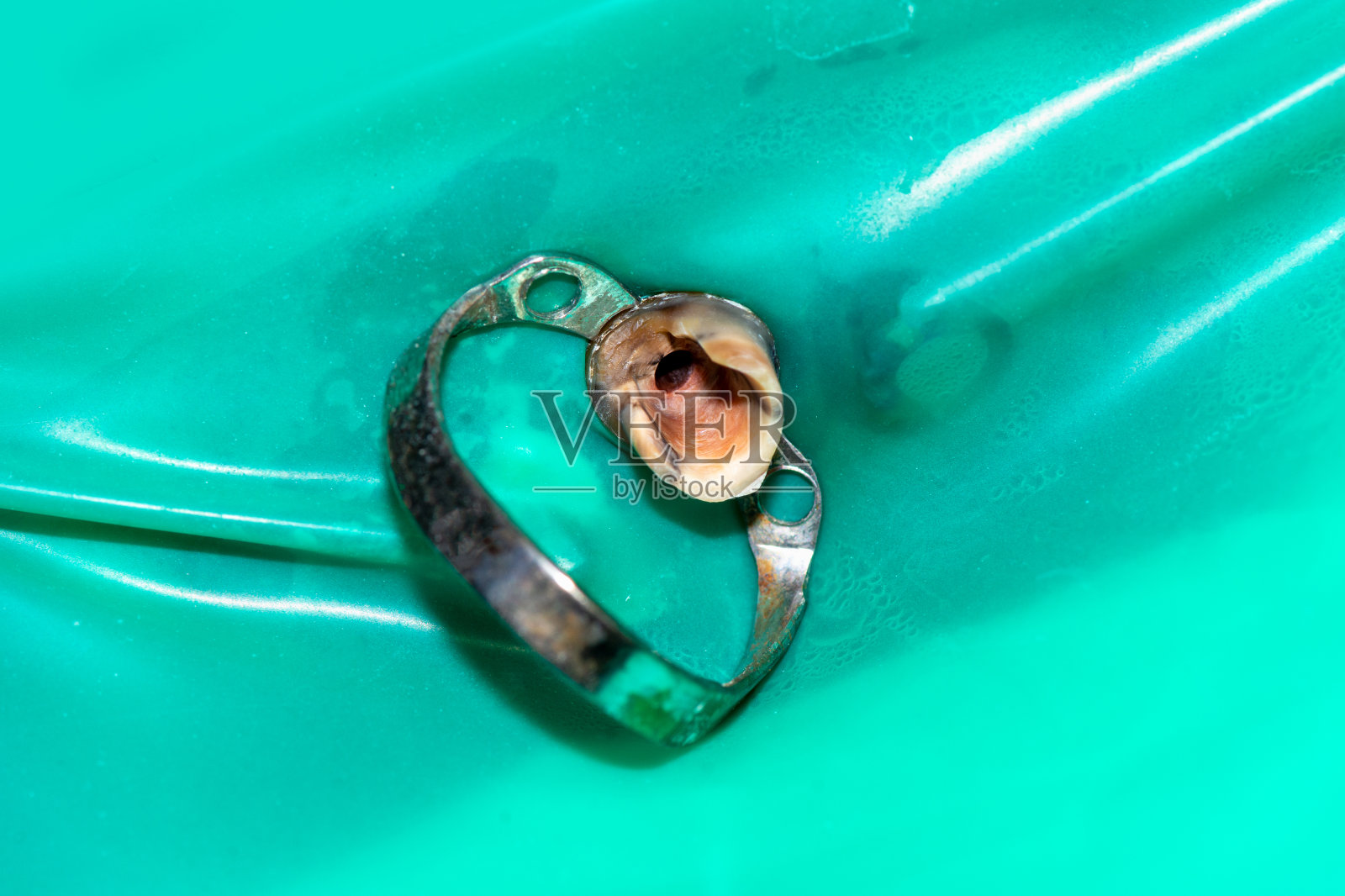 牙科诊所的牙钉和印模制造与安装照片摄影图片