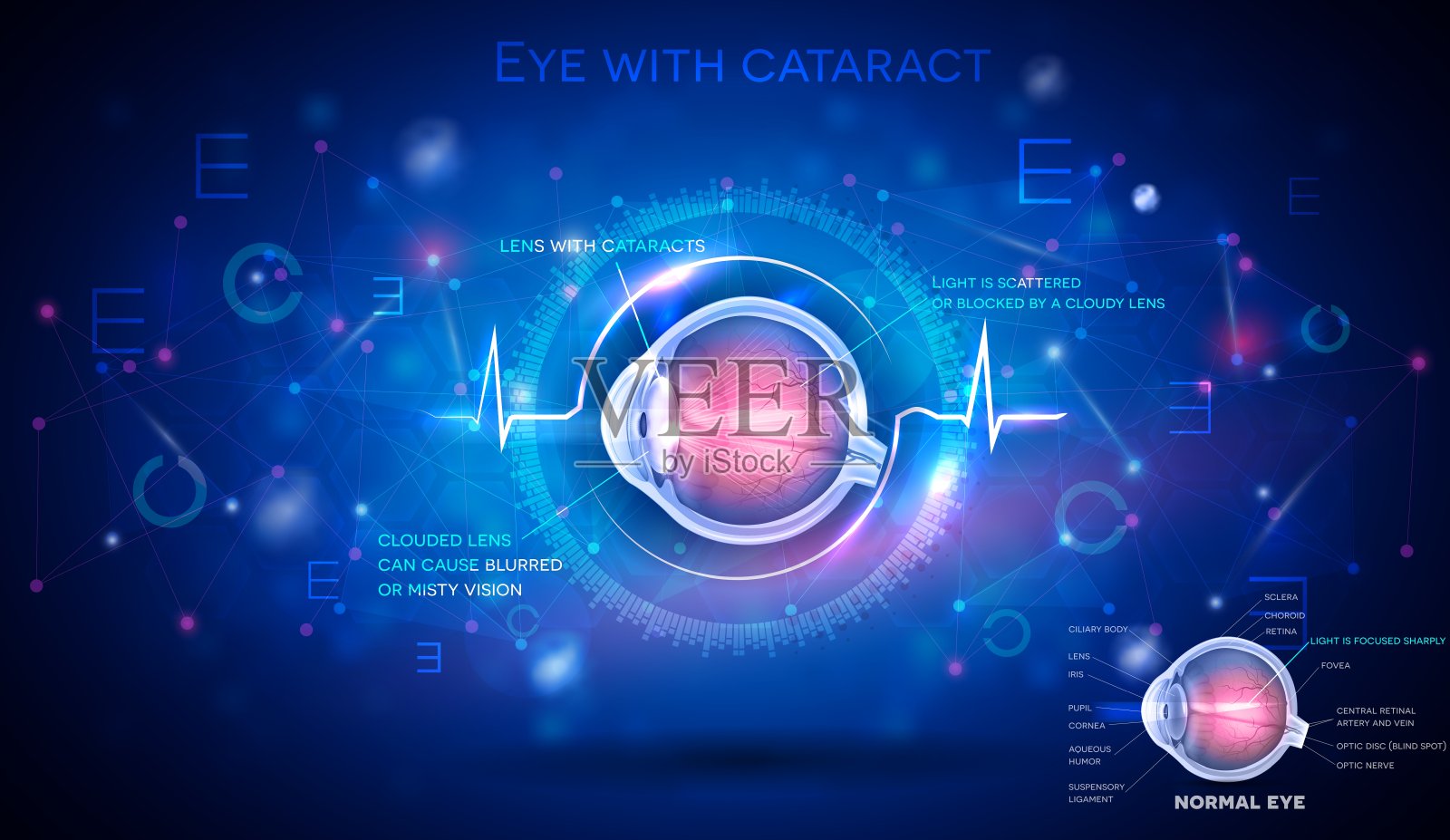 眼睛有白内障插画图片素材