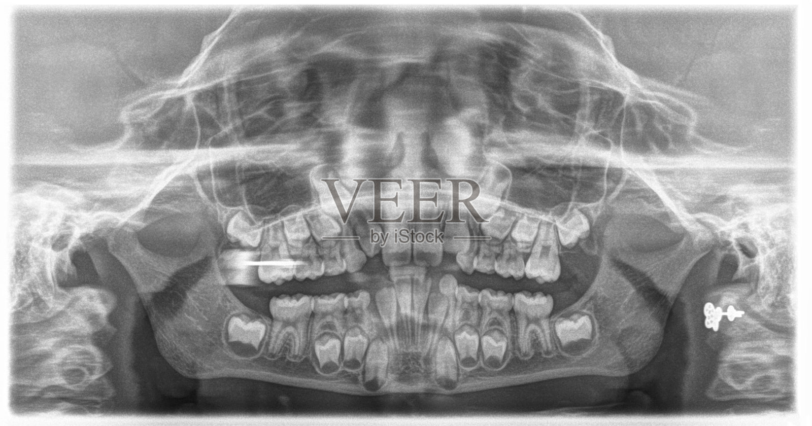 儿童的全景x光牙照片摄影图片