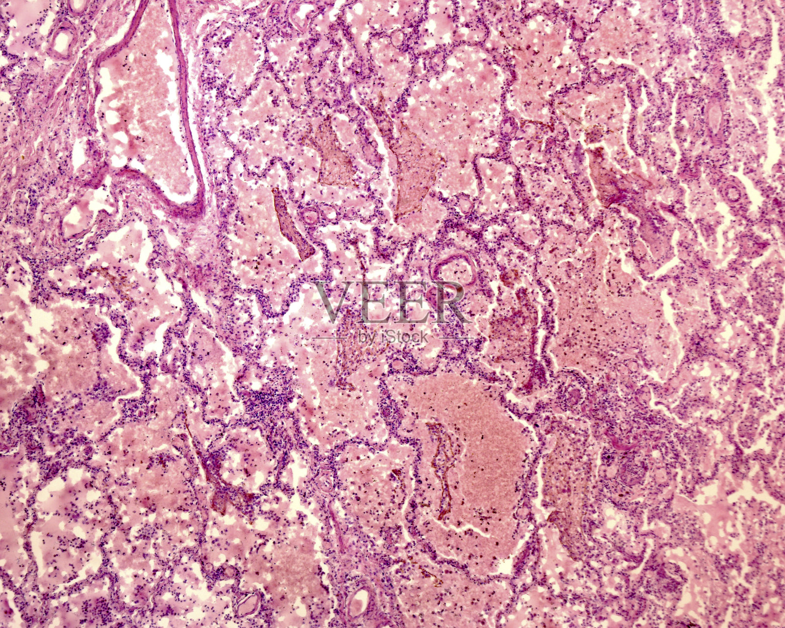 肺。肺炎照片摄影图片