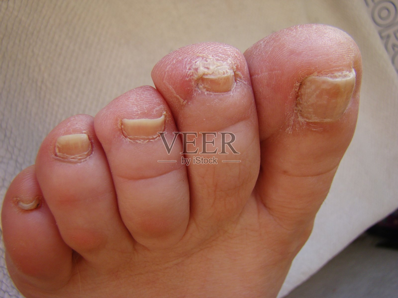 灰指甲照片摄影图片