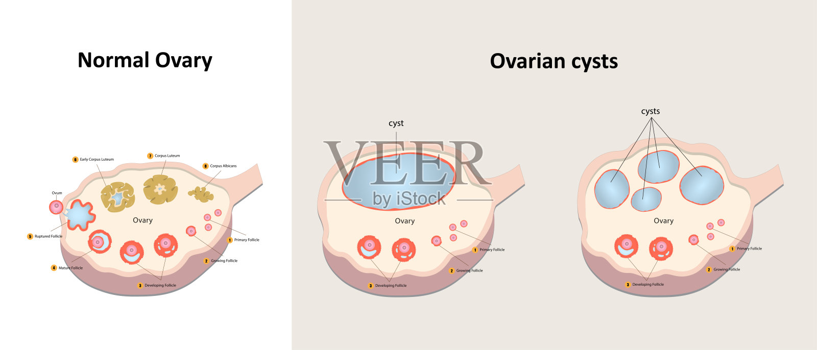 正常卵巢与卵巢囊肿的比较插画图片素材