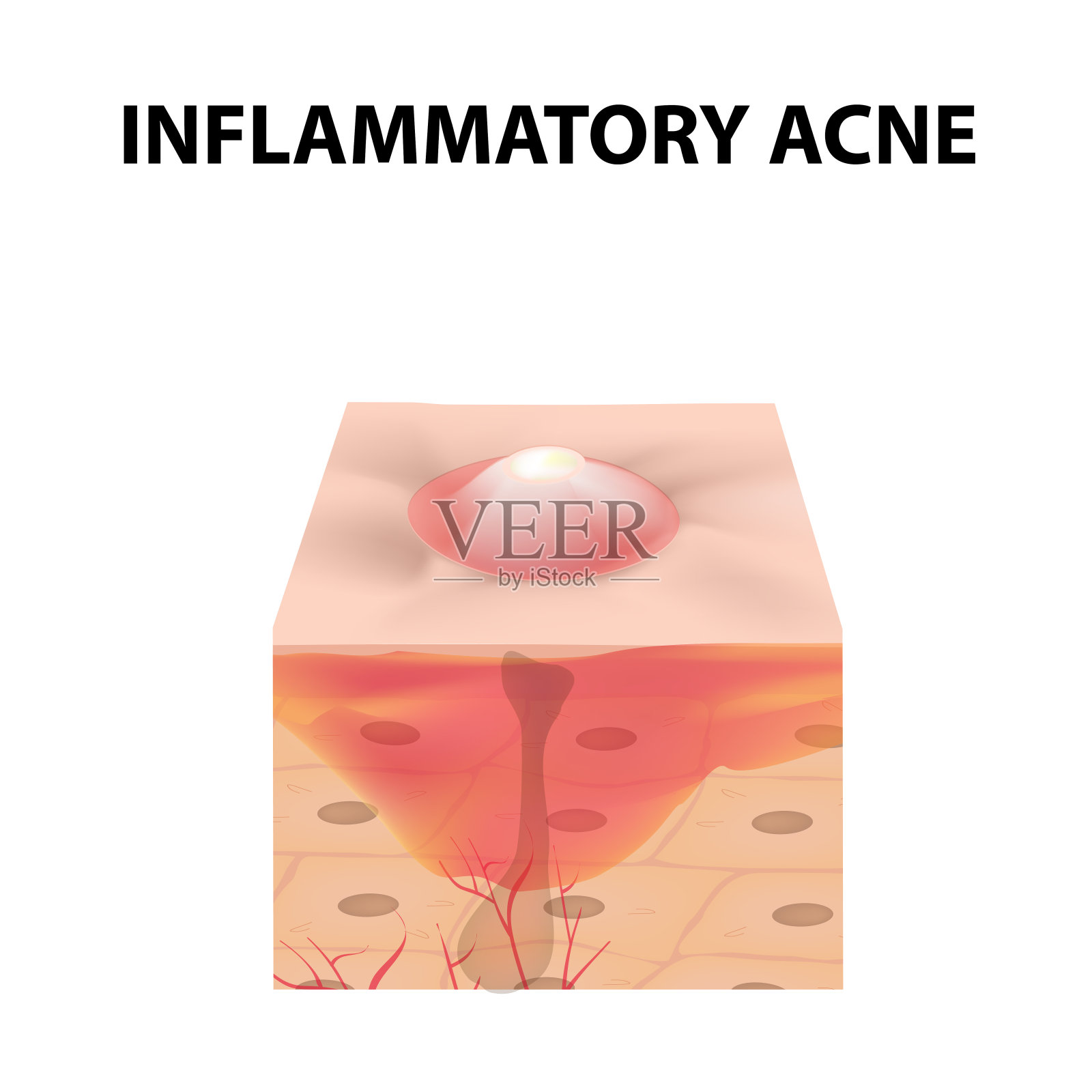 囊肿粉刺。囊肿皮肤上的粉刺。面部皮肤的皮肤病和美容疾病。信息图。矢量插图在孤立的背景。插画图片素材