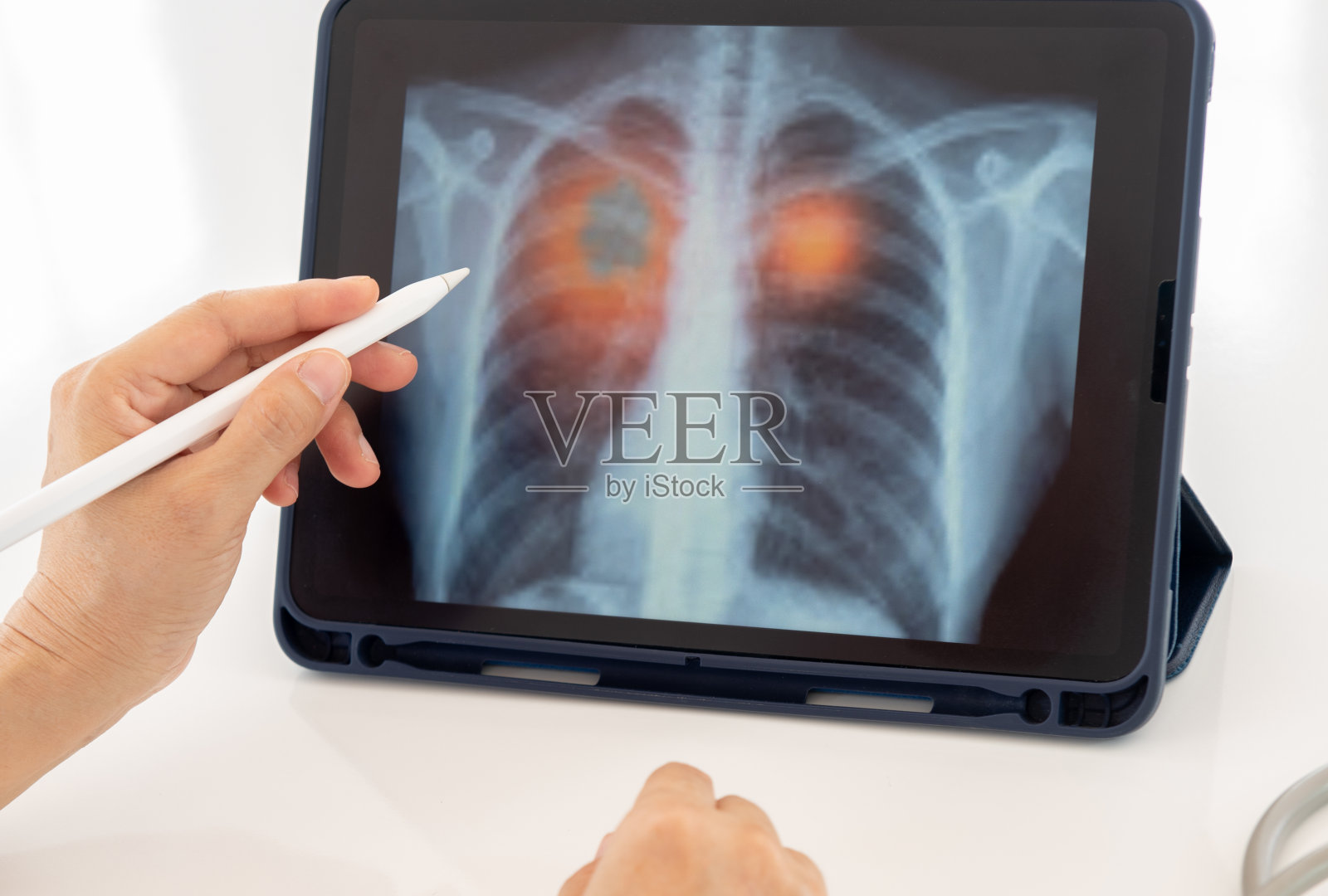 肺炎肺x射线照片摄影图片