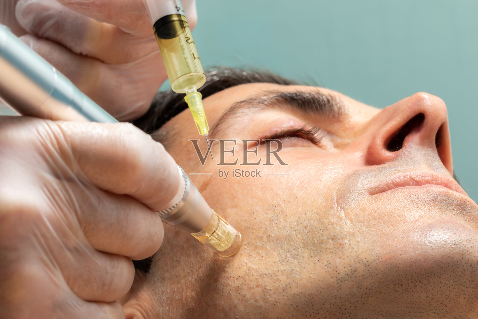 中年男子，面部微针治疗。照片摄影图片