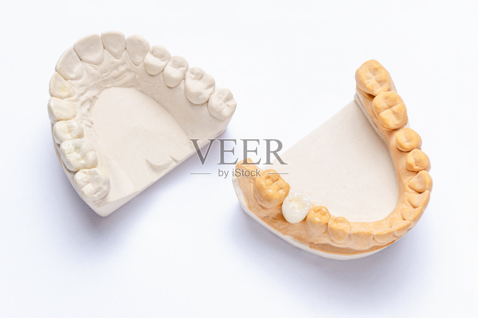 白色的背景上是石膏模型的颌骨和陶瓷冠在臼齿上。种植体上的白色假牙。矫形牙科的概念照片摄影图片