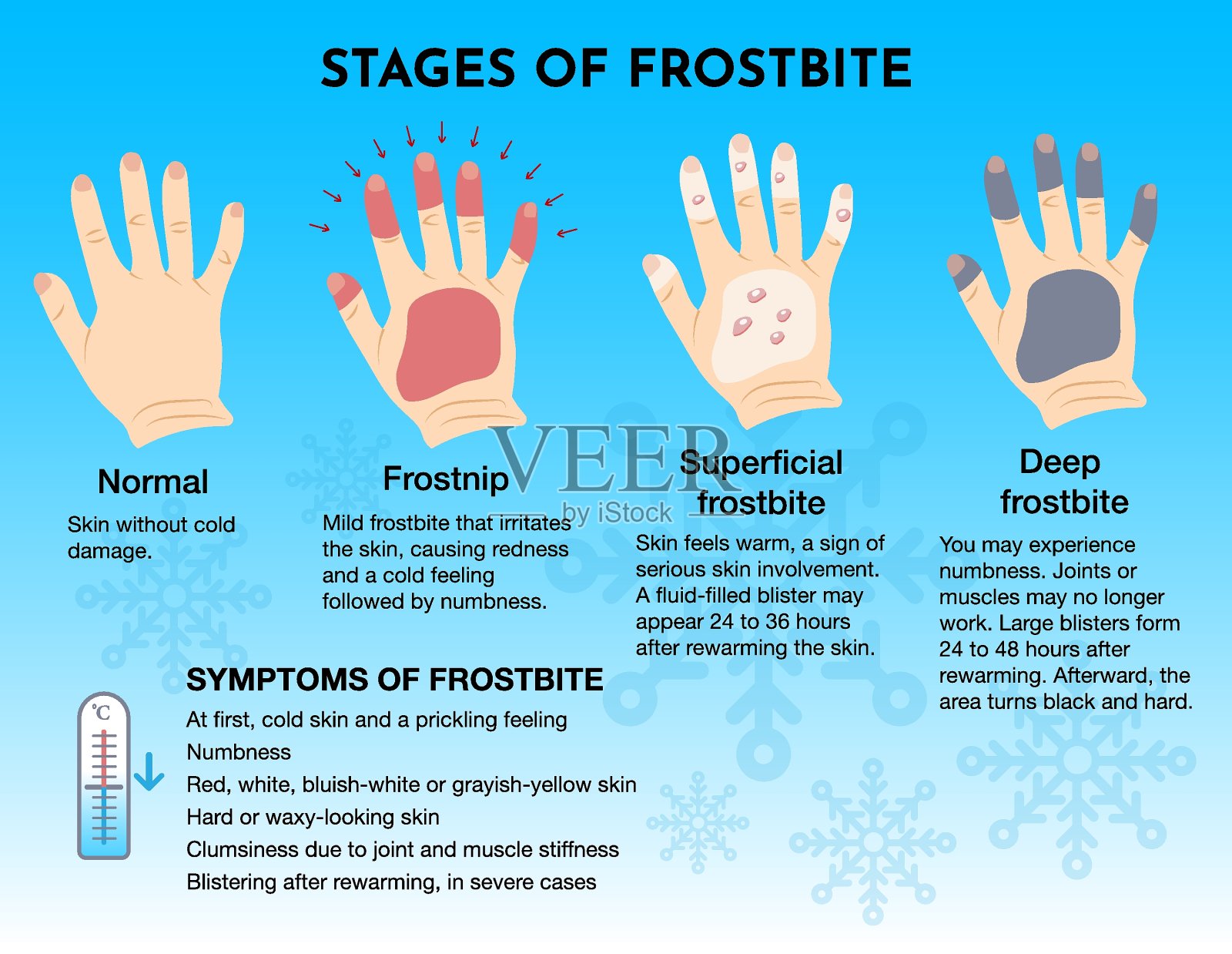 医疗冻伤阶段和急救信息图表。冻僵的手和手指。矢量插图的网页设计。插画图片素材