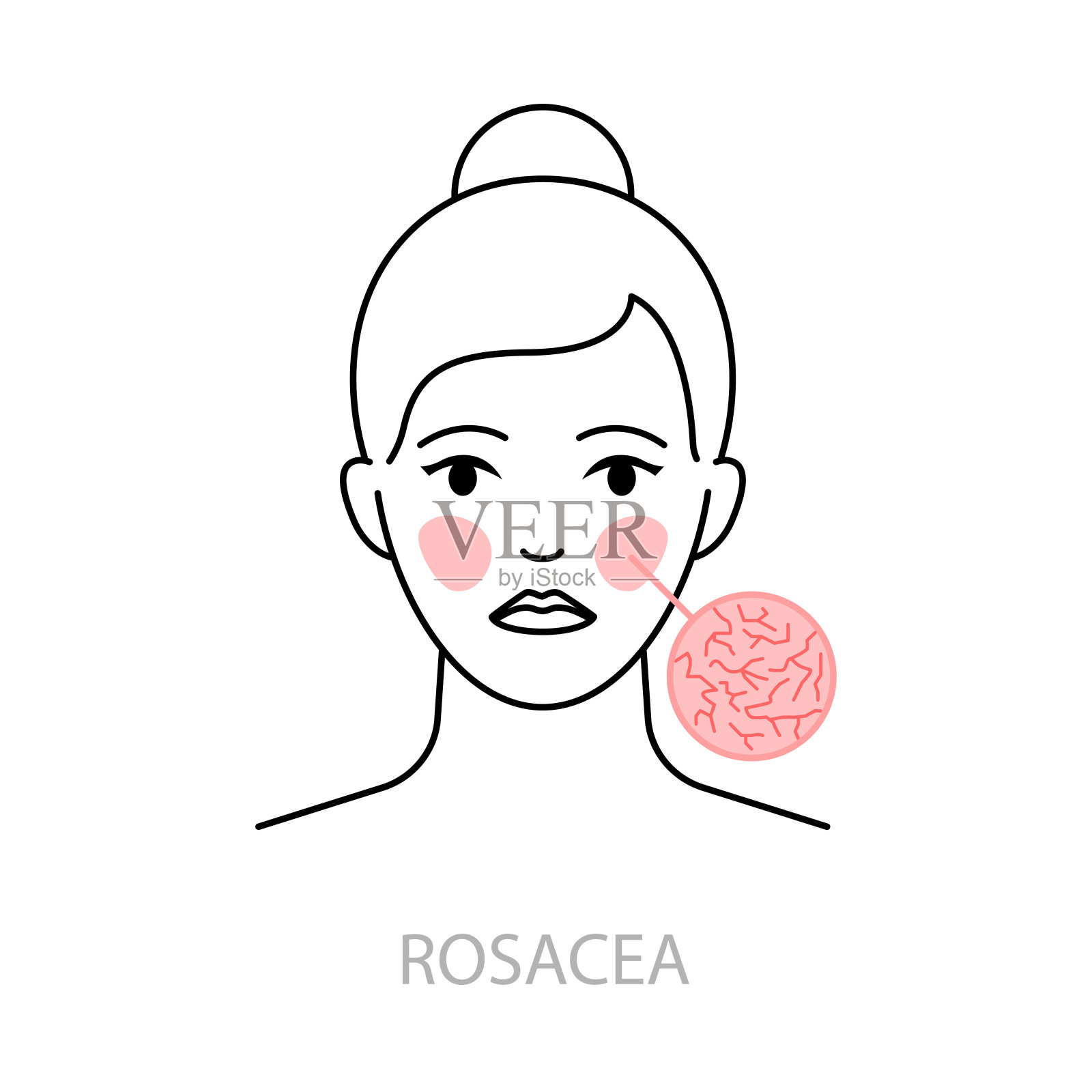 酒糟鼻向量图标线条风格插画图片素材