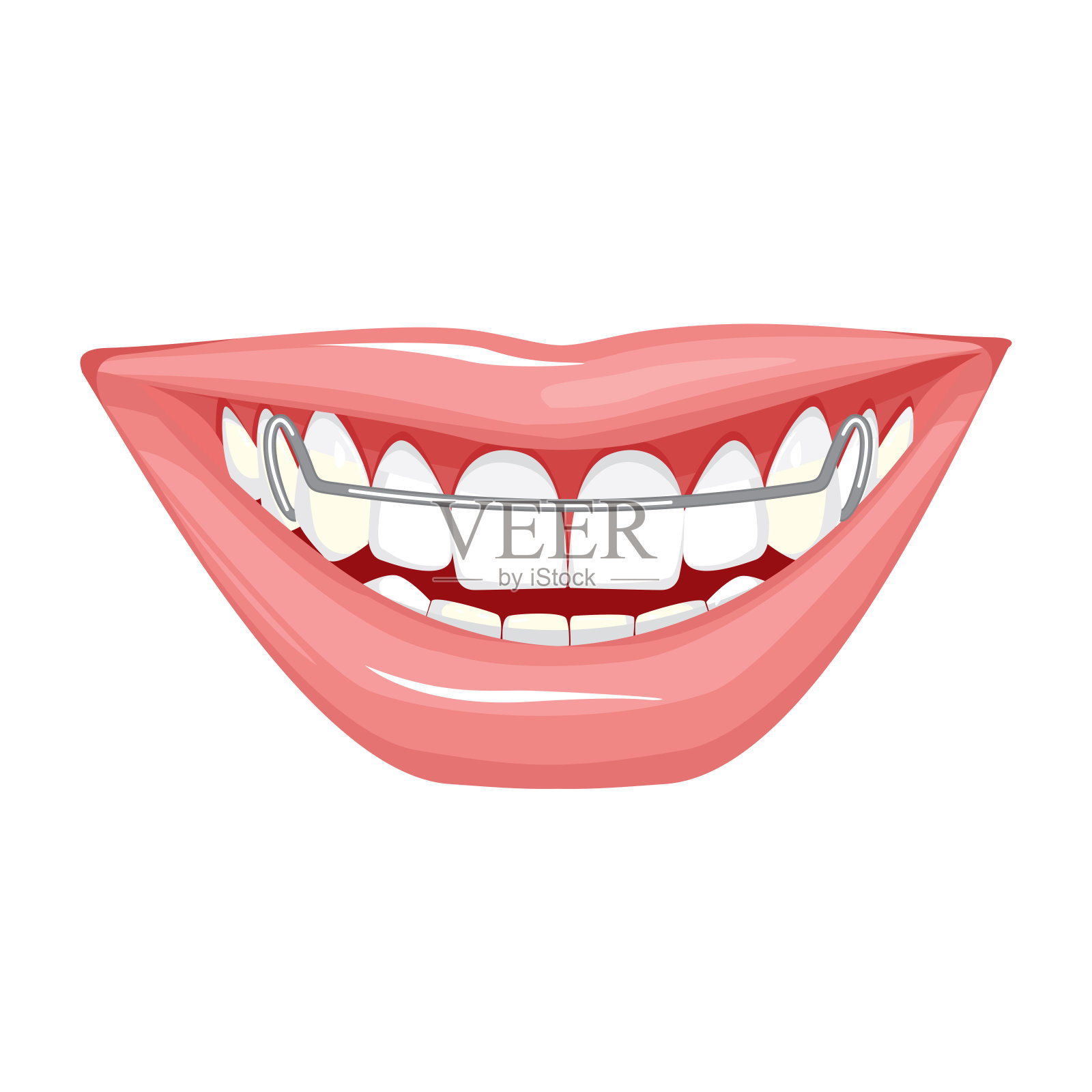 牙齿上的牙套，粉红色的嘴唇和洁白的牙齿插画图片素材