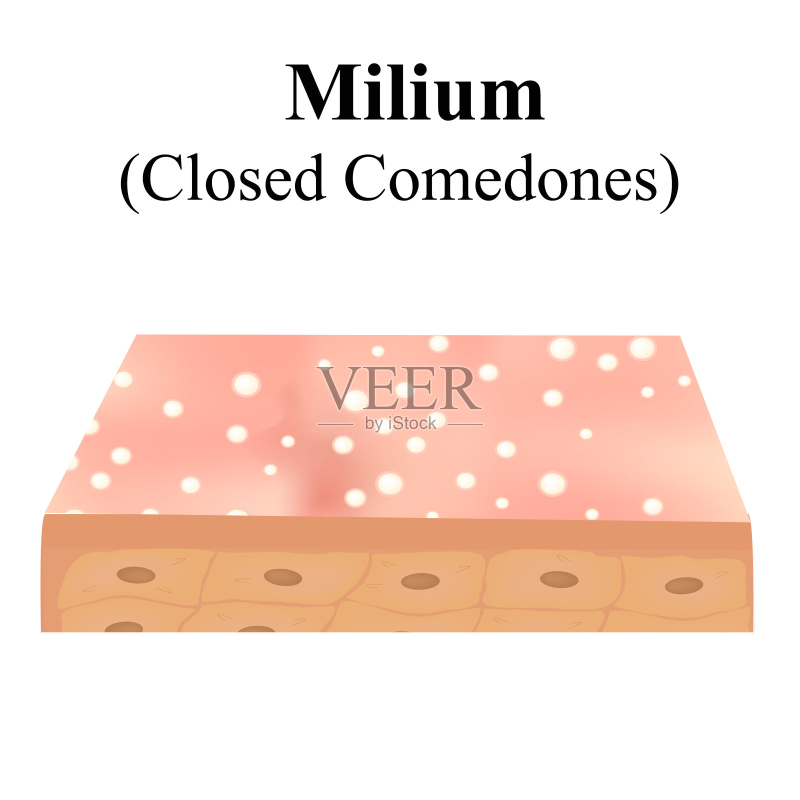 封闭的黑头粉刺。皮肤上的粉刺。皮肤病学和美容疾病对脸上的皮肤痤疮。信息图。矢量插图在孤立的背景。插画图片素材