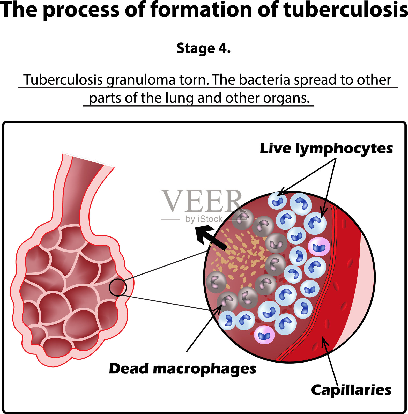 结核病发展到第四阶段插画图片素材