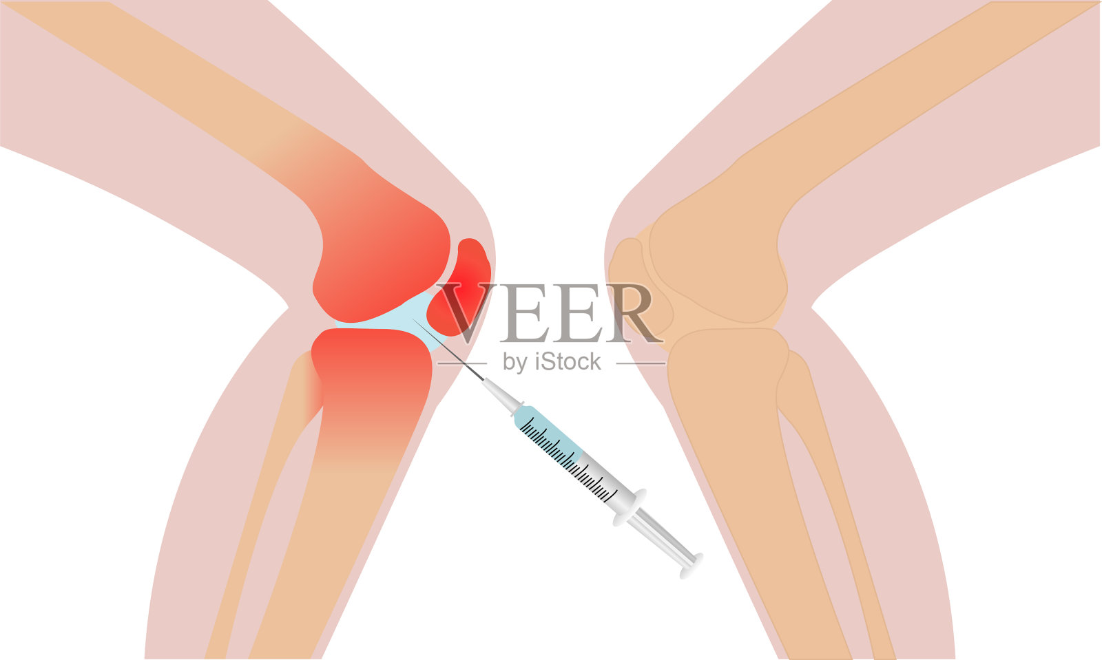 膝关节注射炎症发红设计元素图片