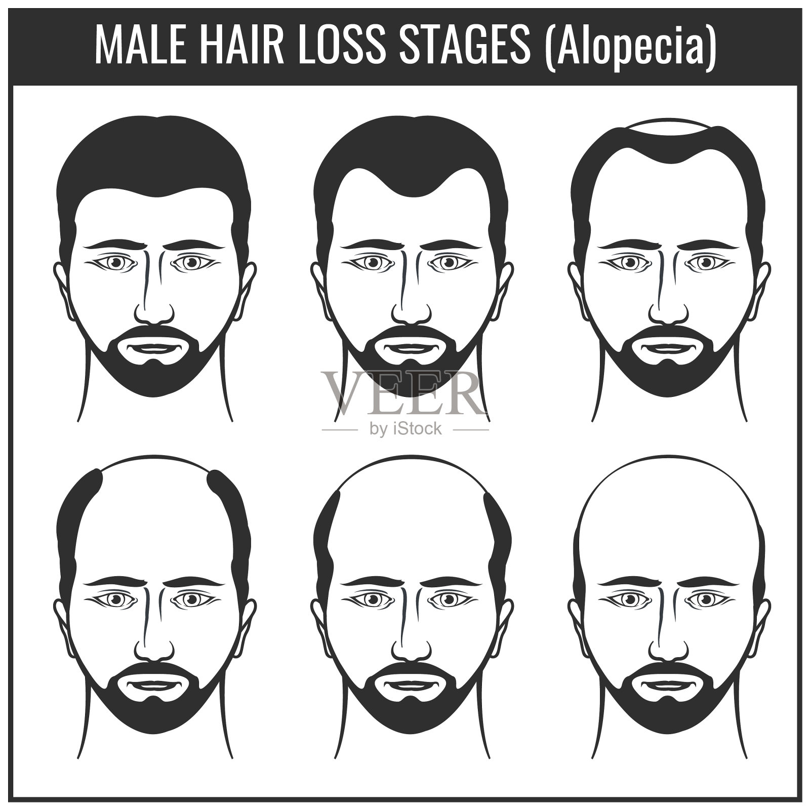 脱发的阶段和类型的脱发男性头发插画图片素材