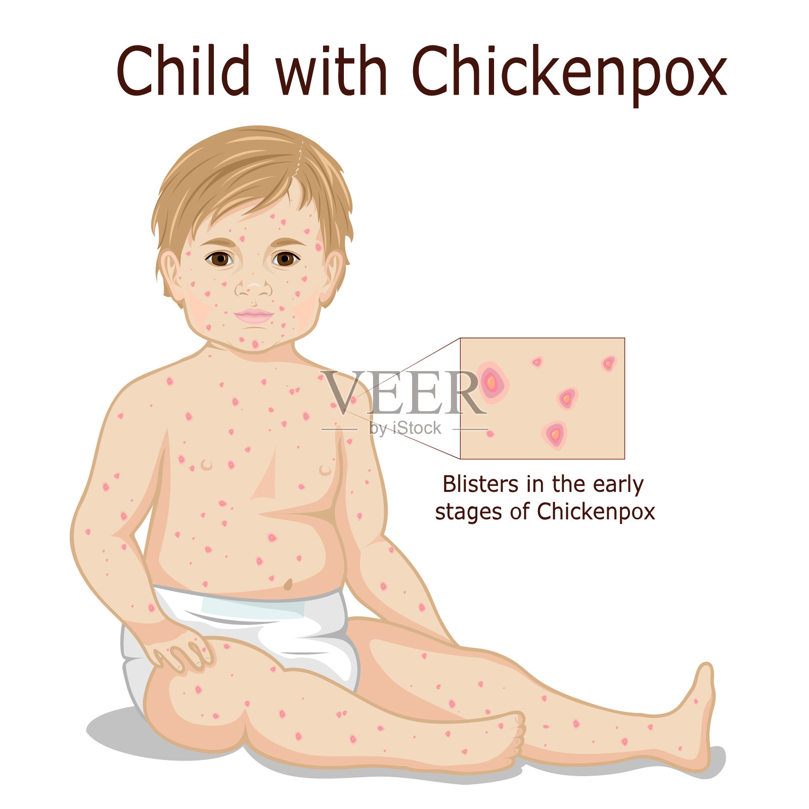 儿童水痘插画图片素材