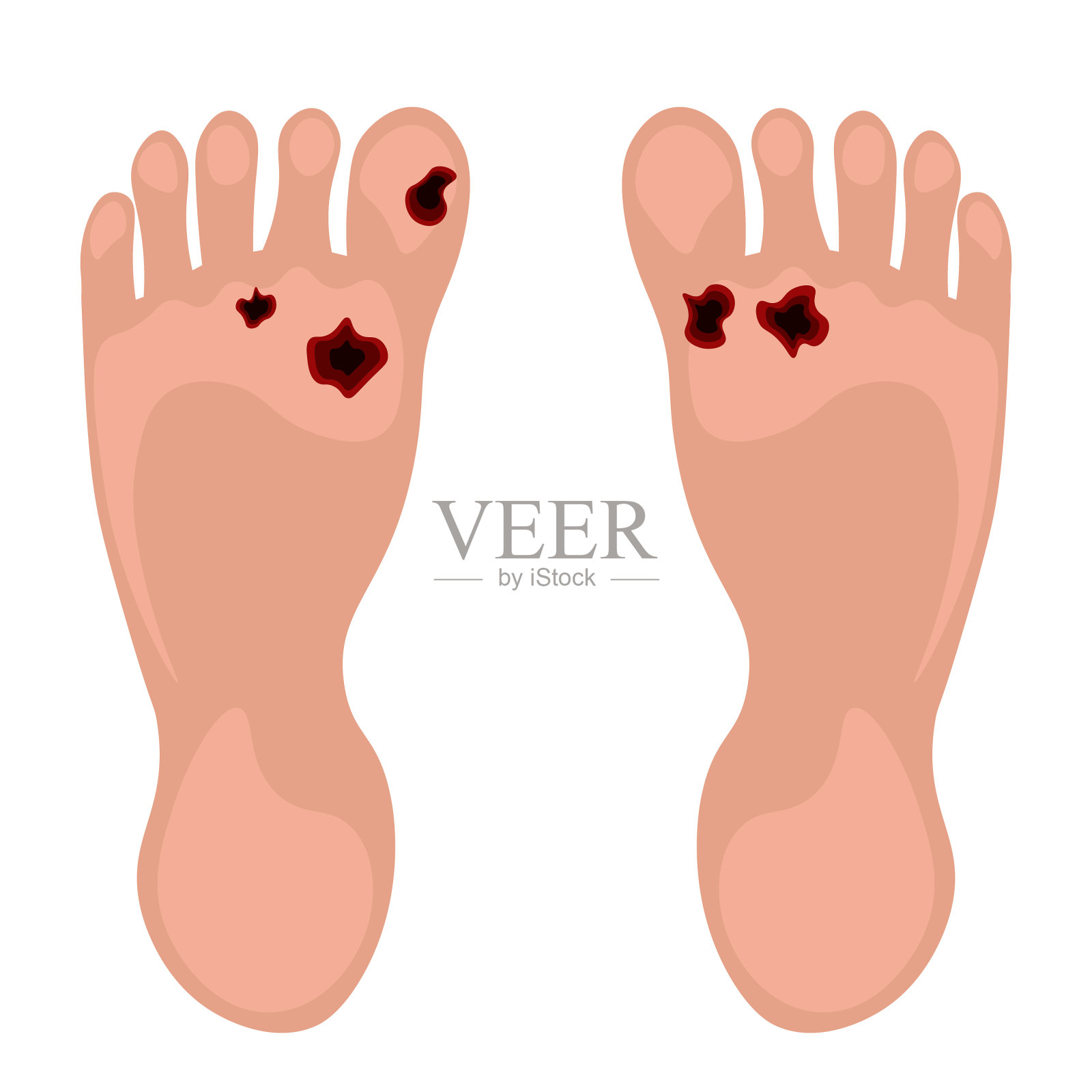 糖尿病足。内分泌系统病理变化。肢体缺血、动脉粥样硬化。矢量插图。插画图片素材