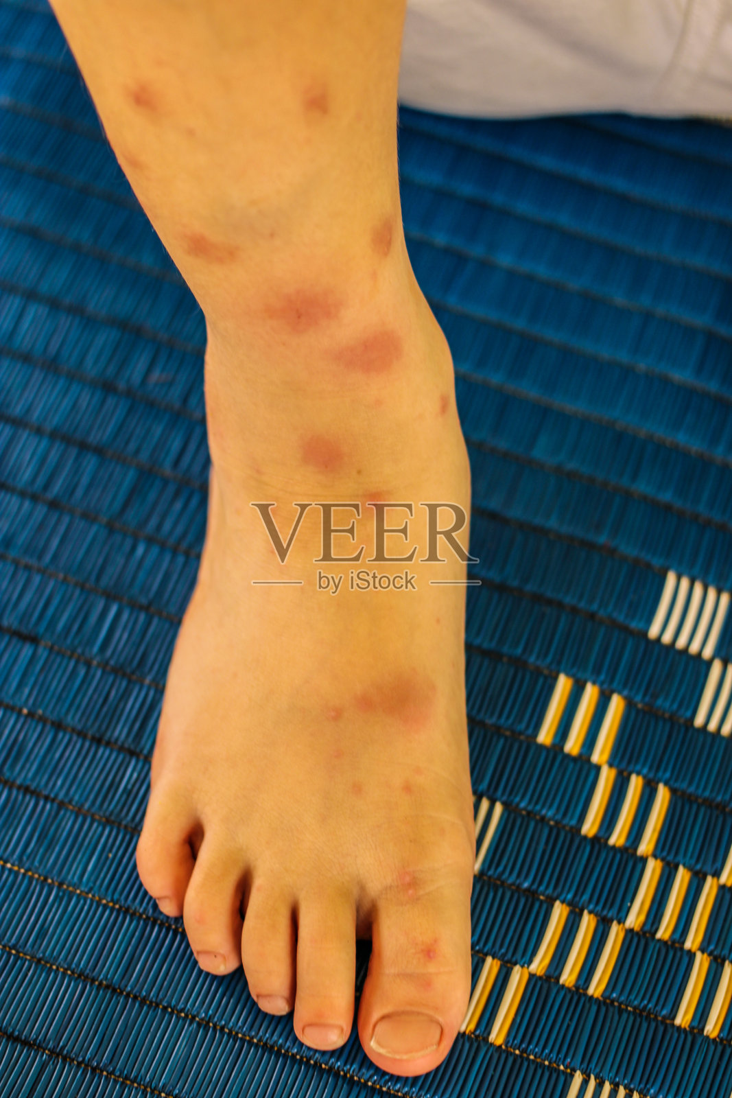 蚊子腿咬照片摄影图片