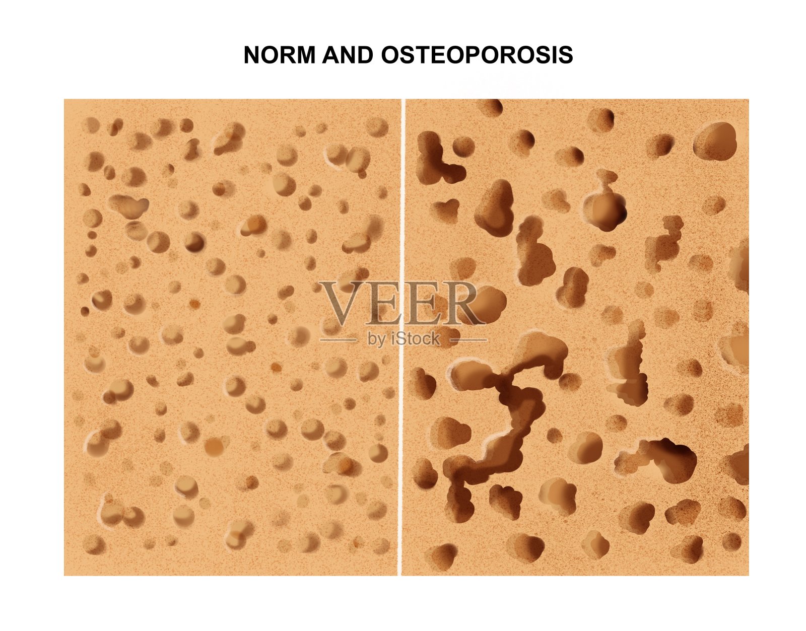 骨质疏松症的过程照片摄影图片