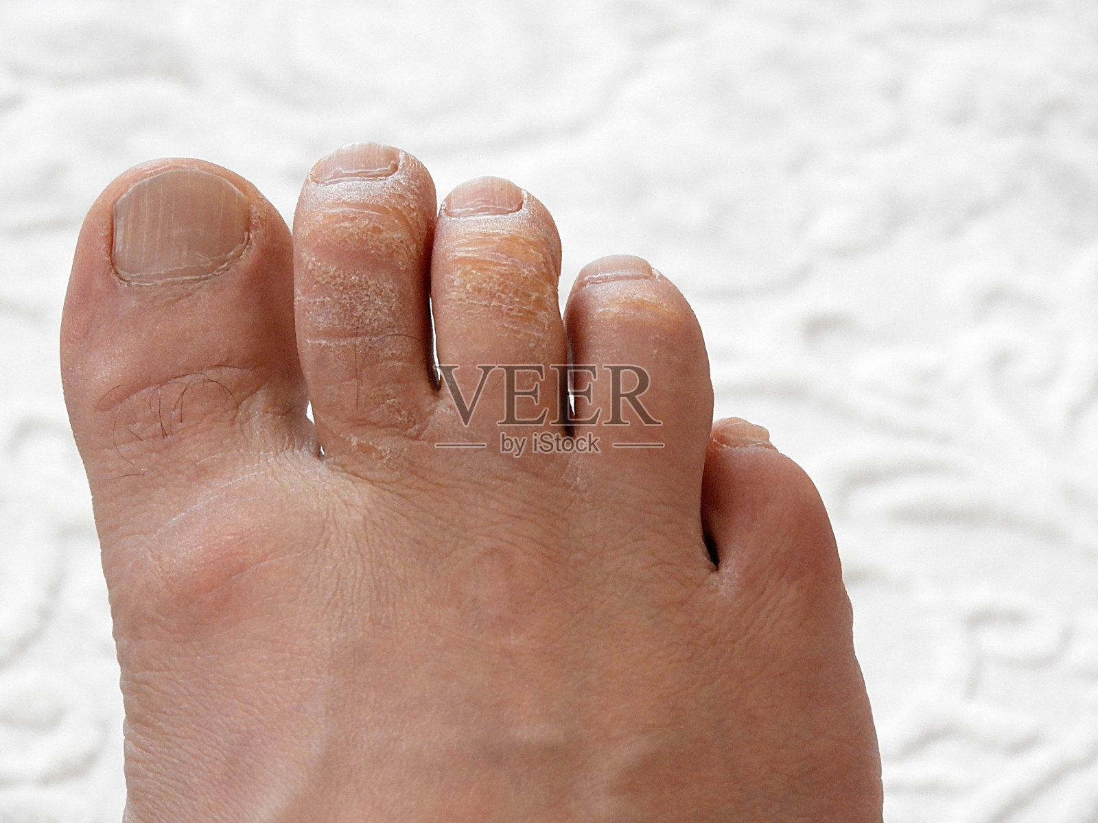 一种脚趾上的真菌病，脚上的皮肤病，照片摄影图片