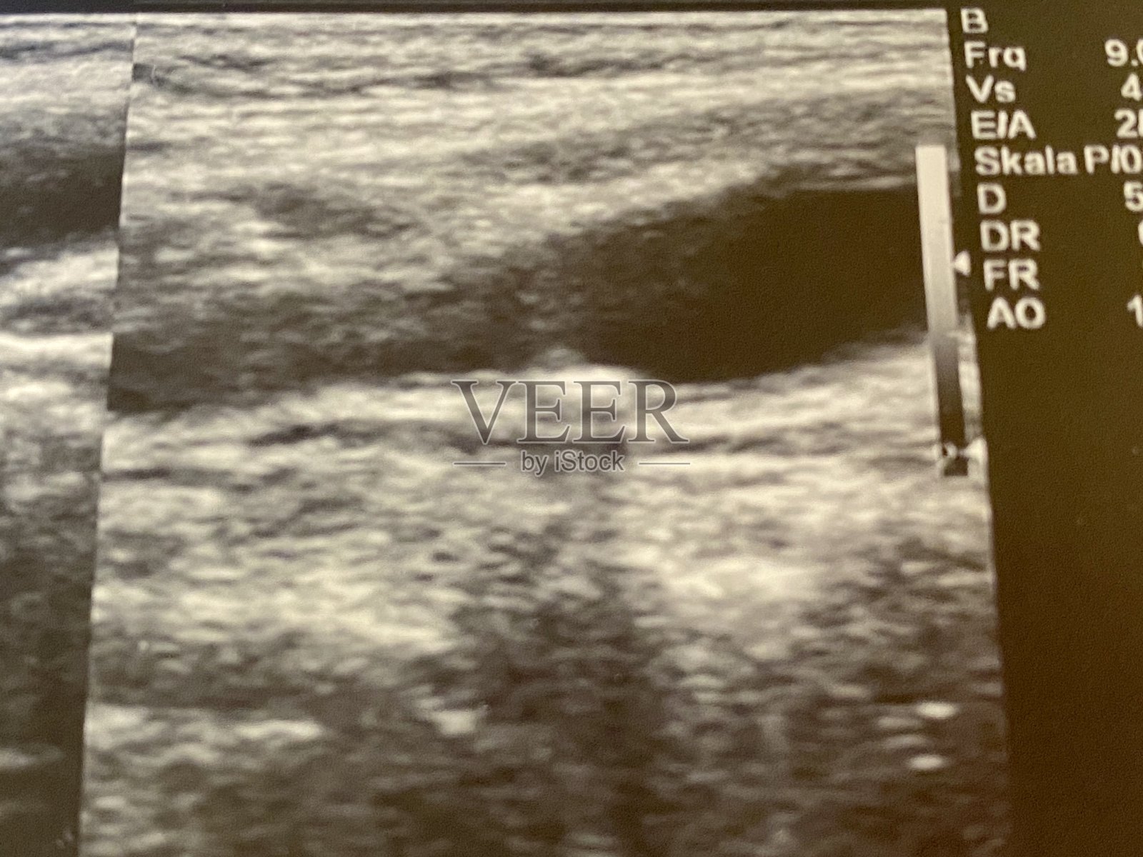 人颈动脉粥样硬化斑块的超声图像照片摄影图片
