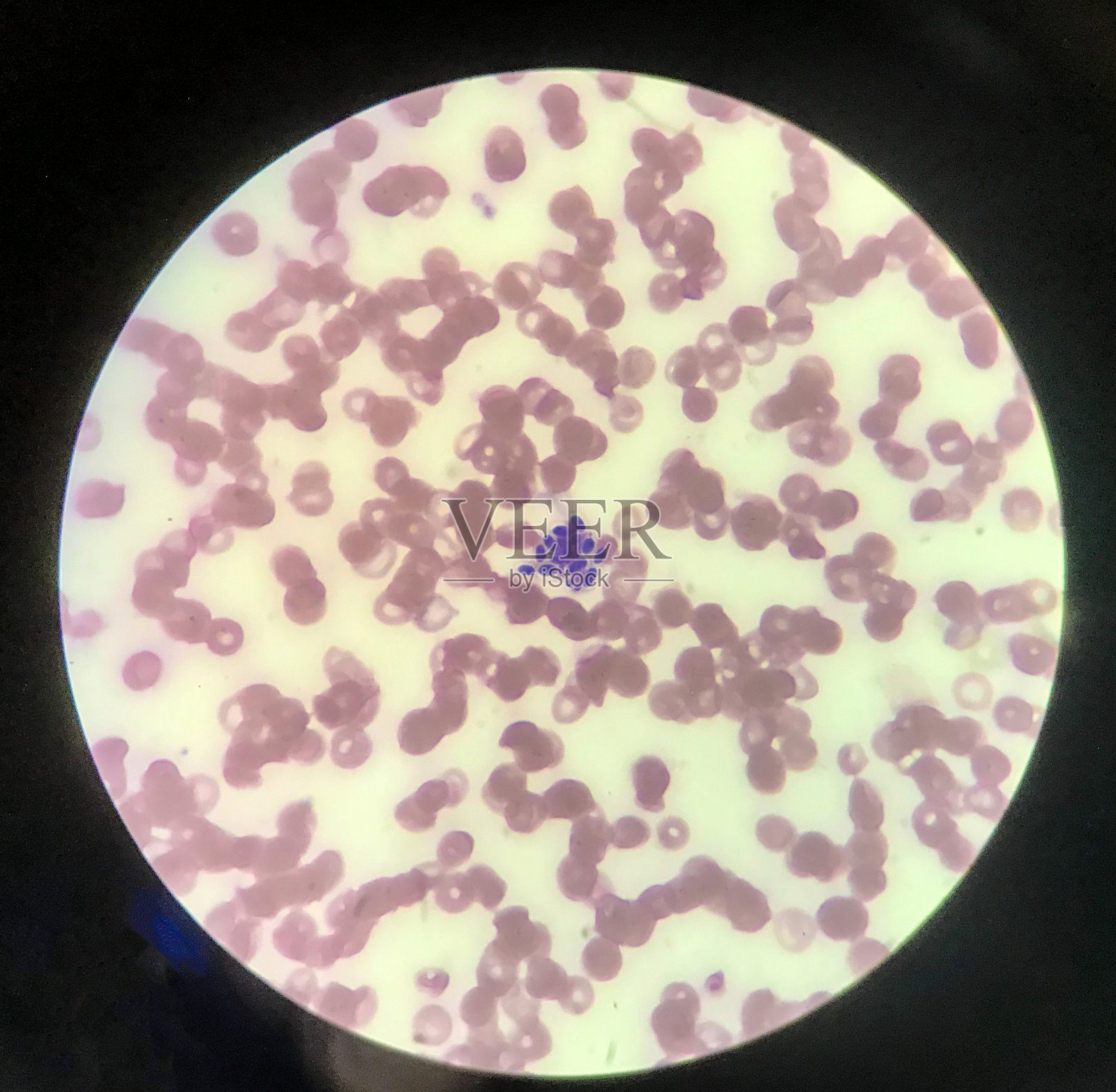 血液涂片中的白细胞吞噬酵母菌细胞。真菌血液感染医学背景。照片摄影图片