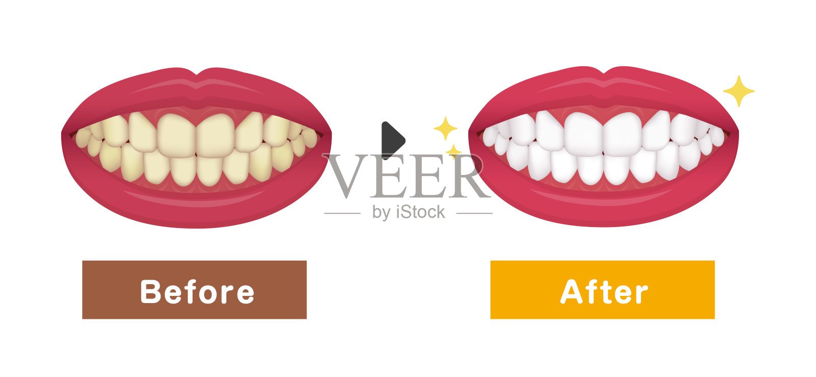 牙齿美白矢量插图/之前和之后插画图片素材