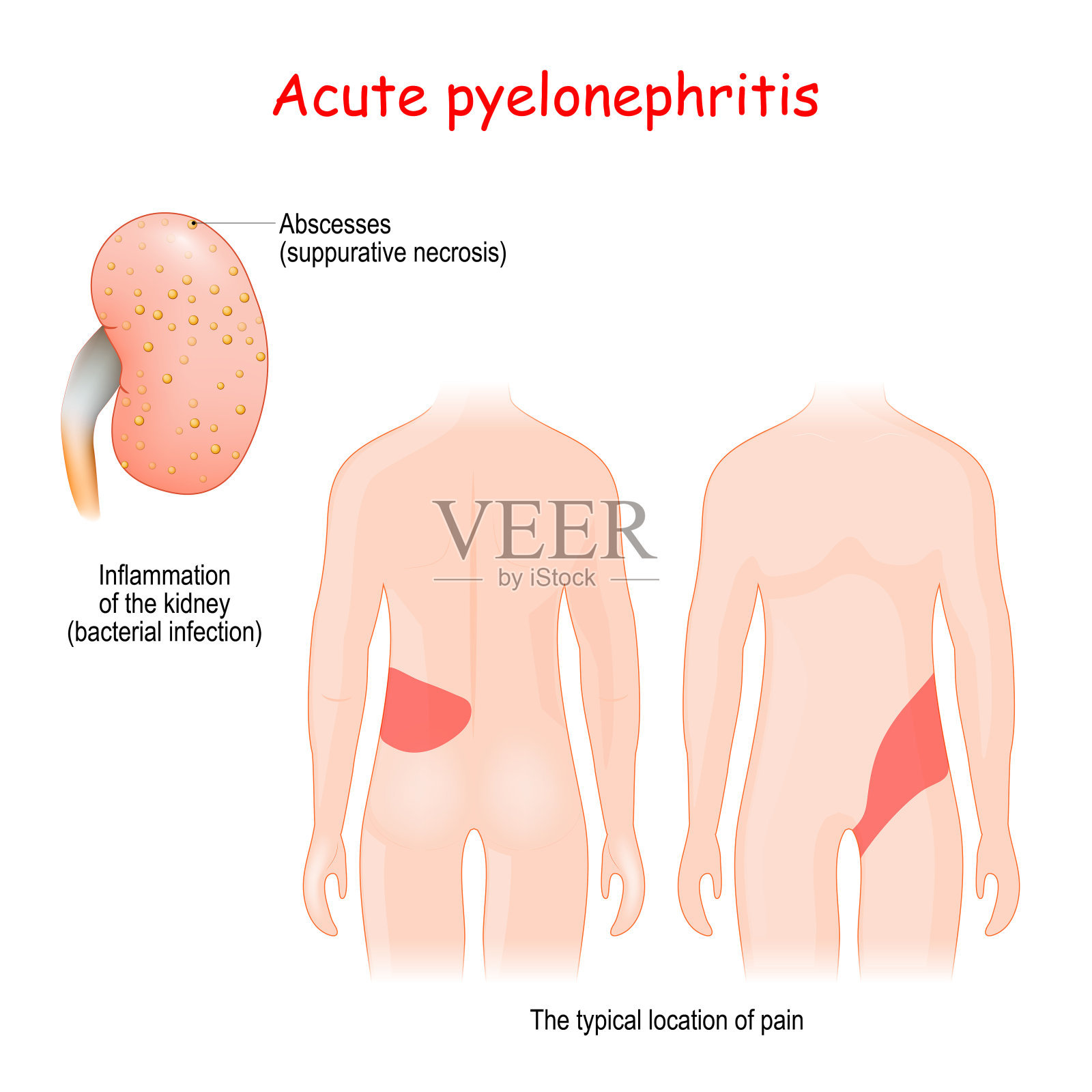 急性肾盂肾炎。肾炎肾脏的炎症插画图片素材