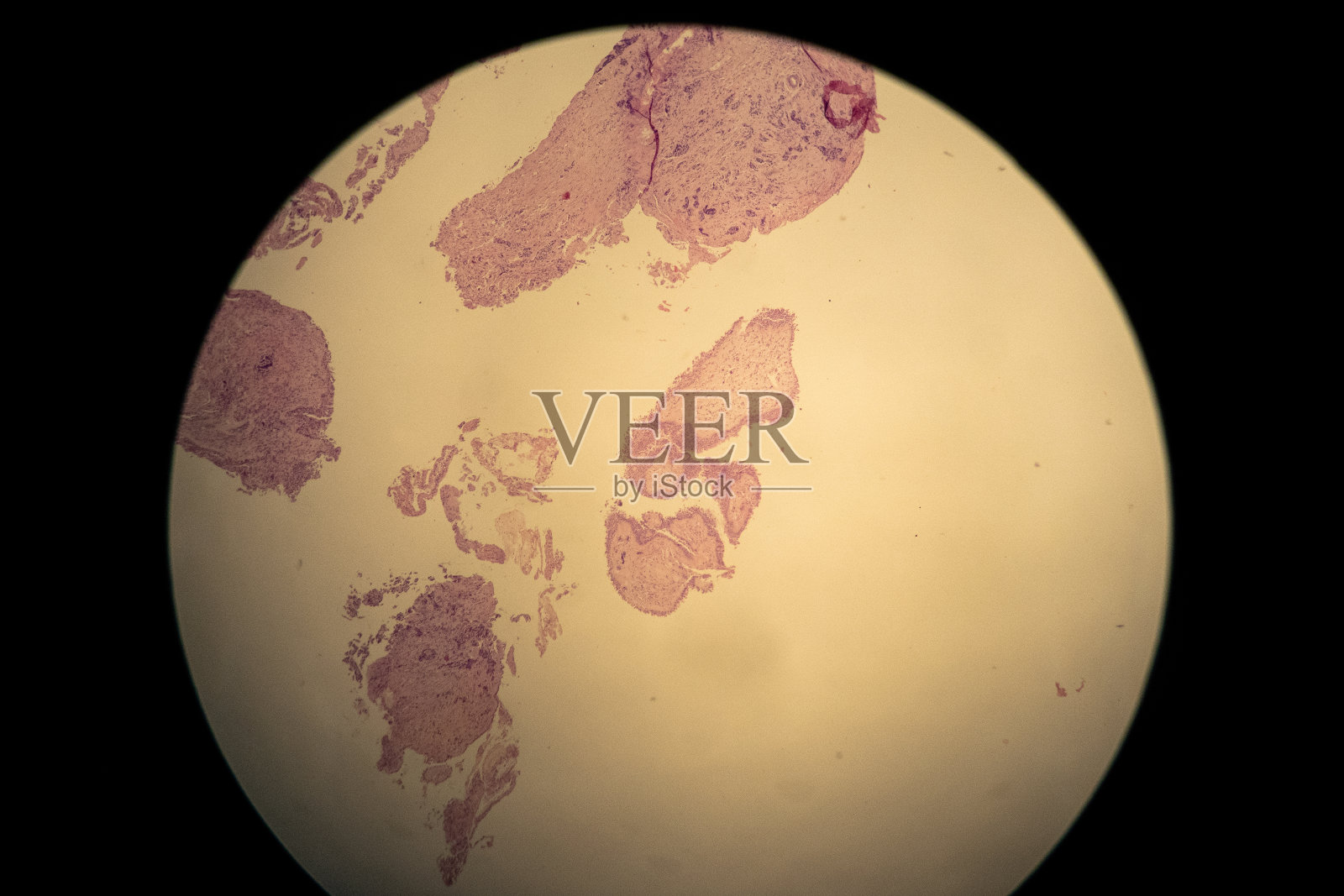 胸膜活检，肺结核。Abrahms针。肉芽肿。照片摄影图片