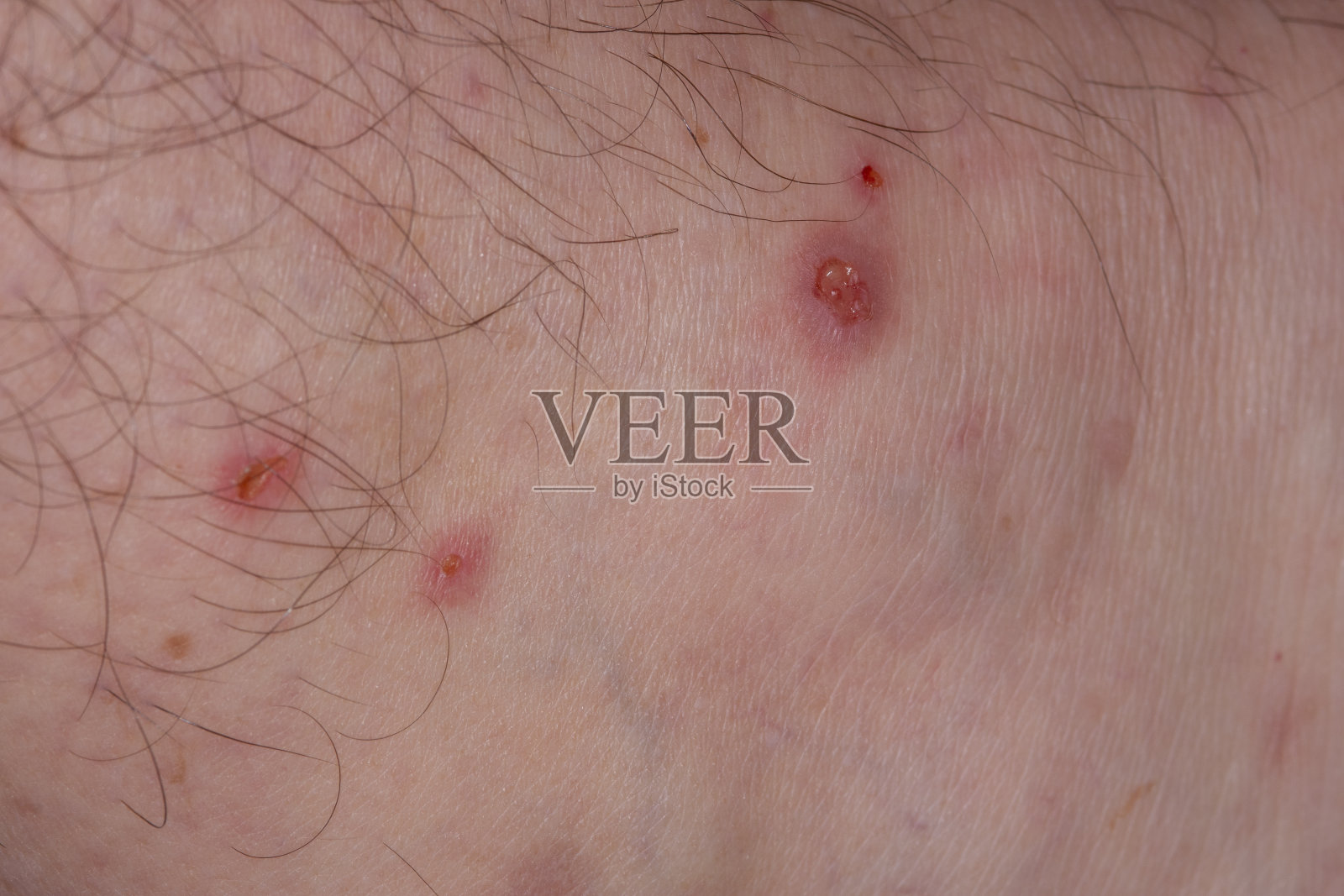 白种人脚踝处被蜱虫咬伤照片摄影图片