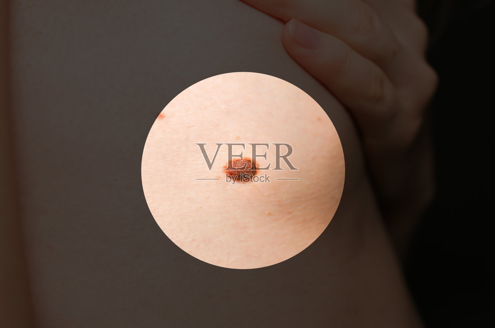 那女孩皮肤上有个大胎记。医疗卫生的照片。照片摄影图片