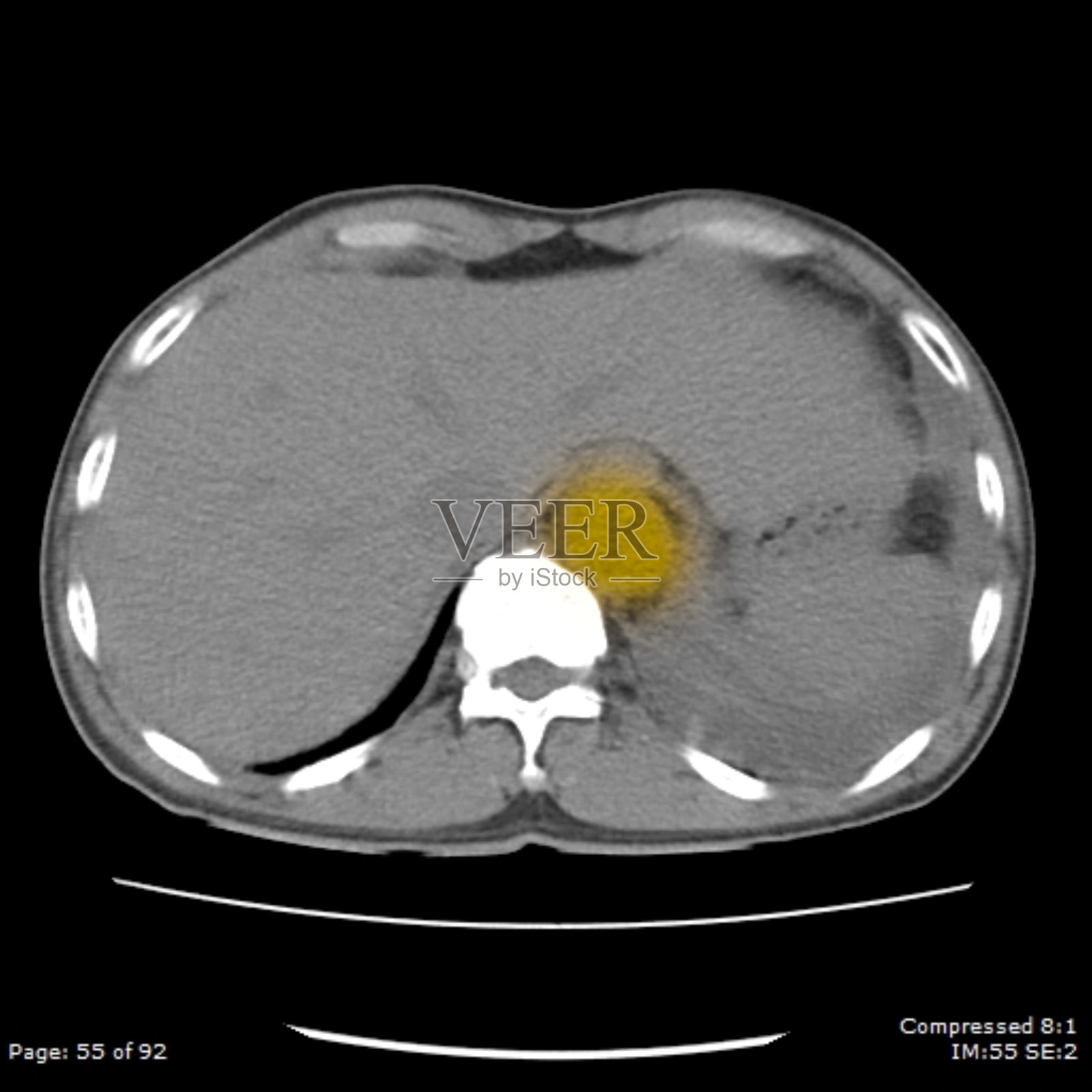 CT体位图轴位黄斑示主动脉异常增大照片摄影图片