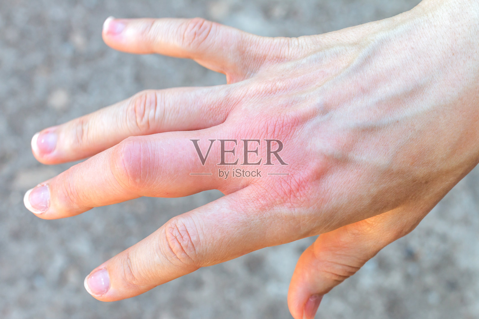 被蜜蜂咬后，手指又肿又红照片摄影图片