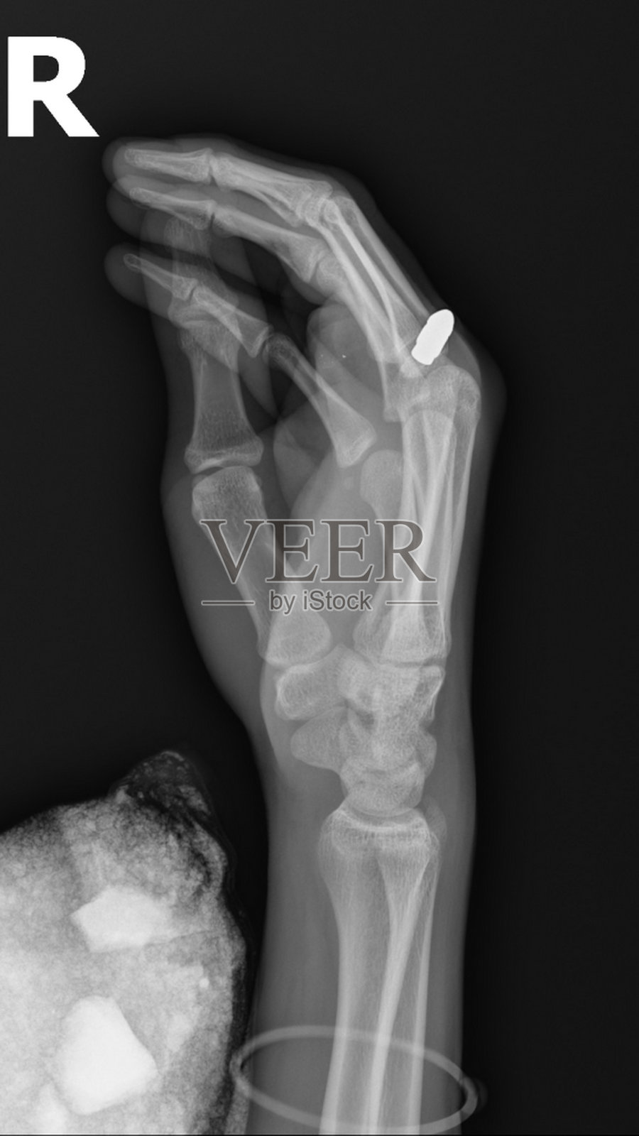 x光显示手上有子弹男性16岁照片摄影图片