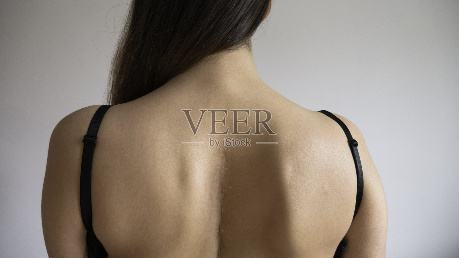 白人女人的上背部有疤。照片摄影图片