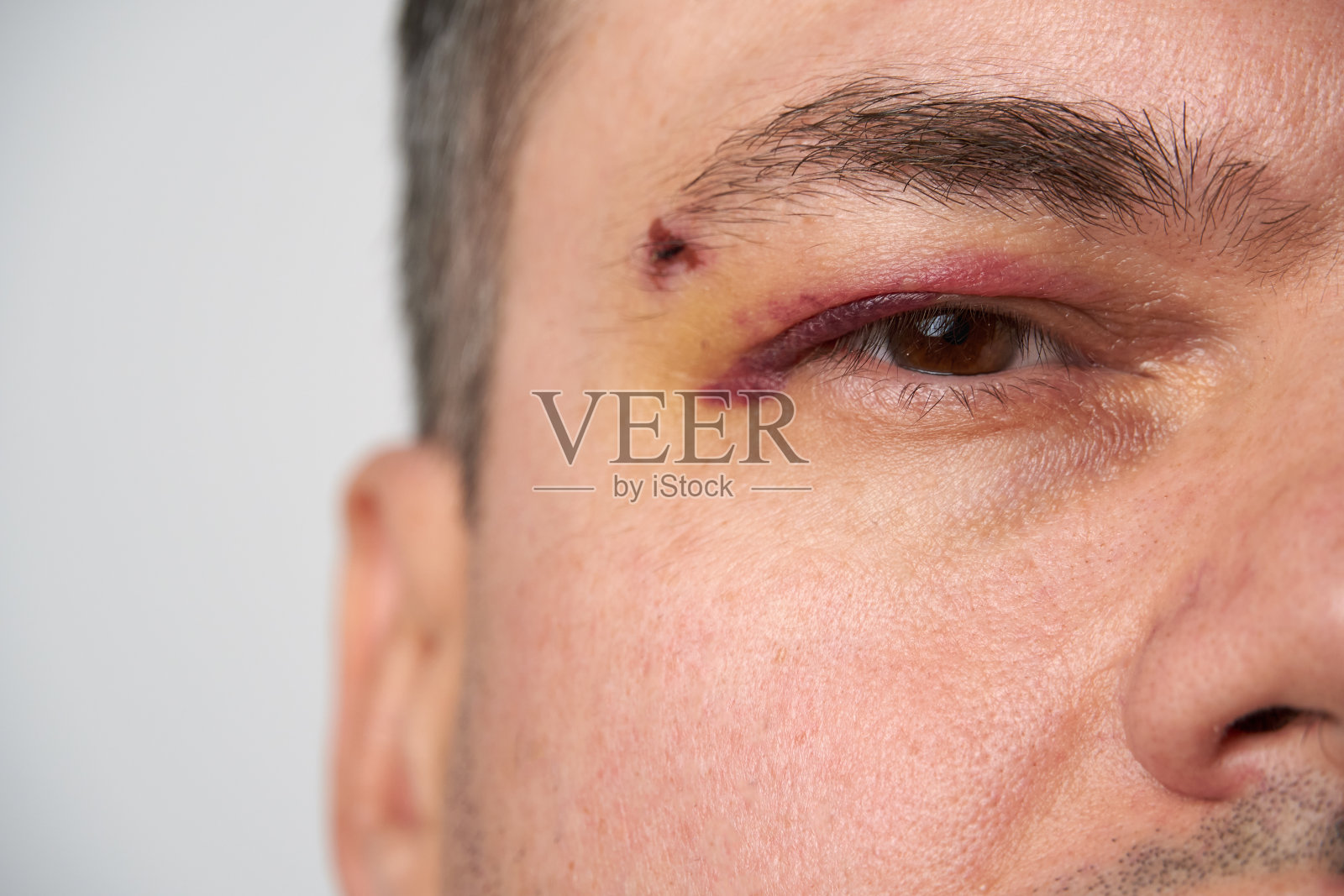 近距离观察眼睛附近的淤青，一个有血肿的男人的脸照片摄影图片