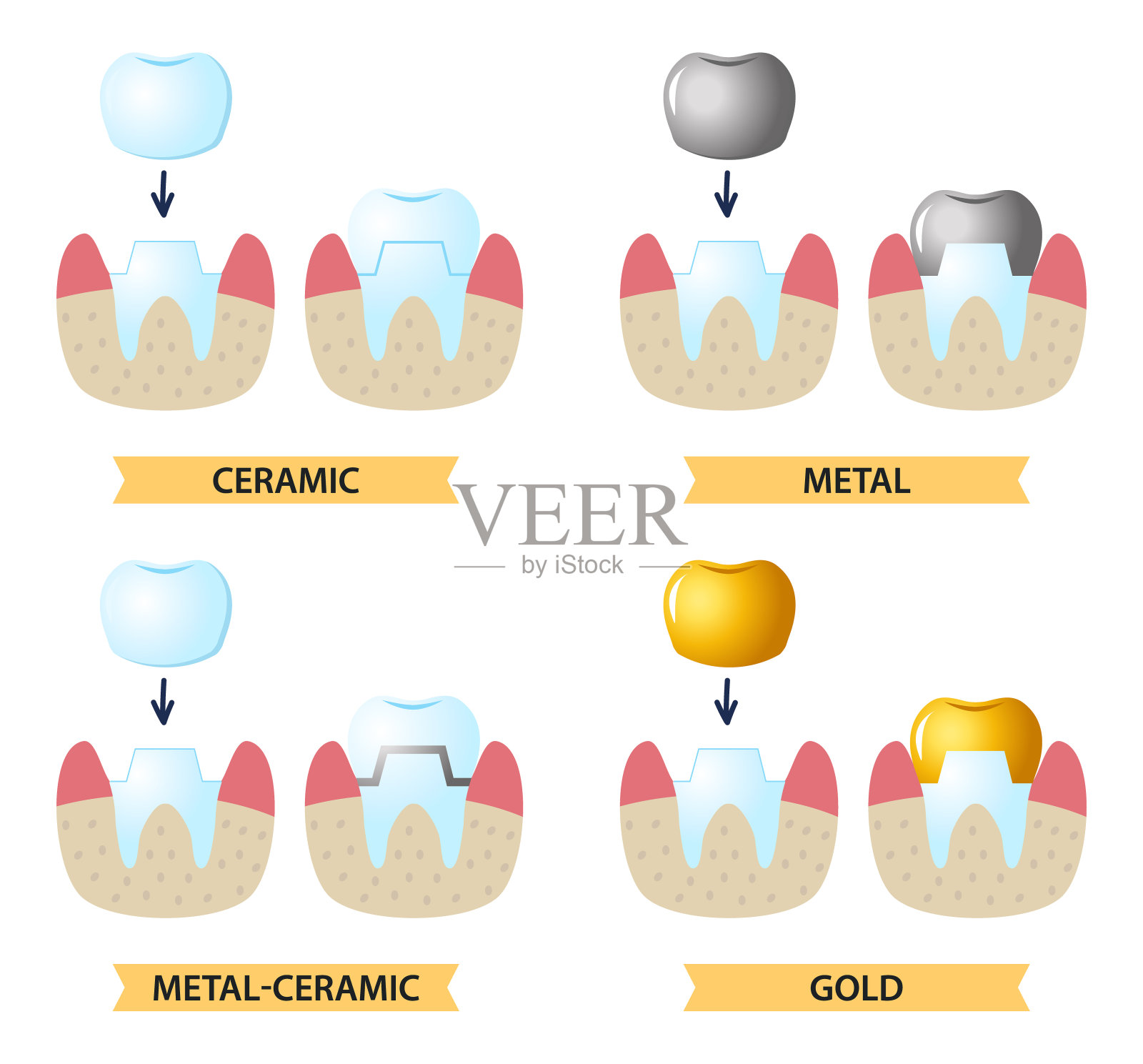 牙科主题上的图标。陶瓷冠的服务安装。插画图片素材