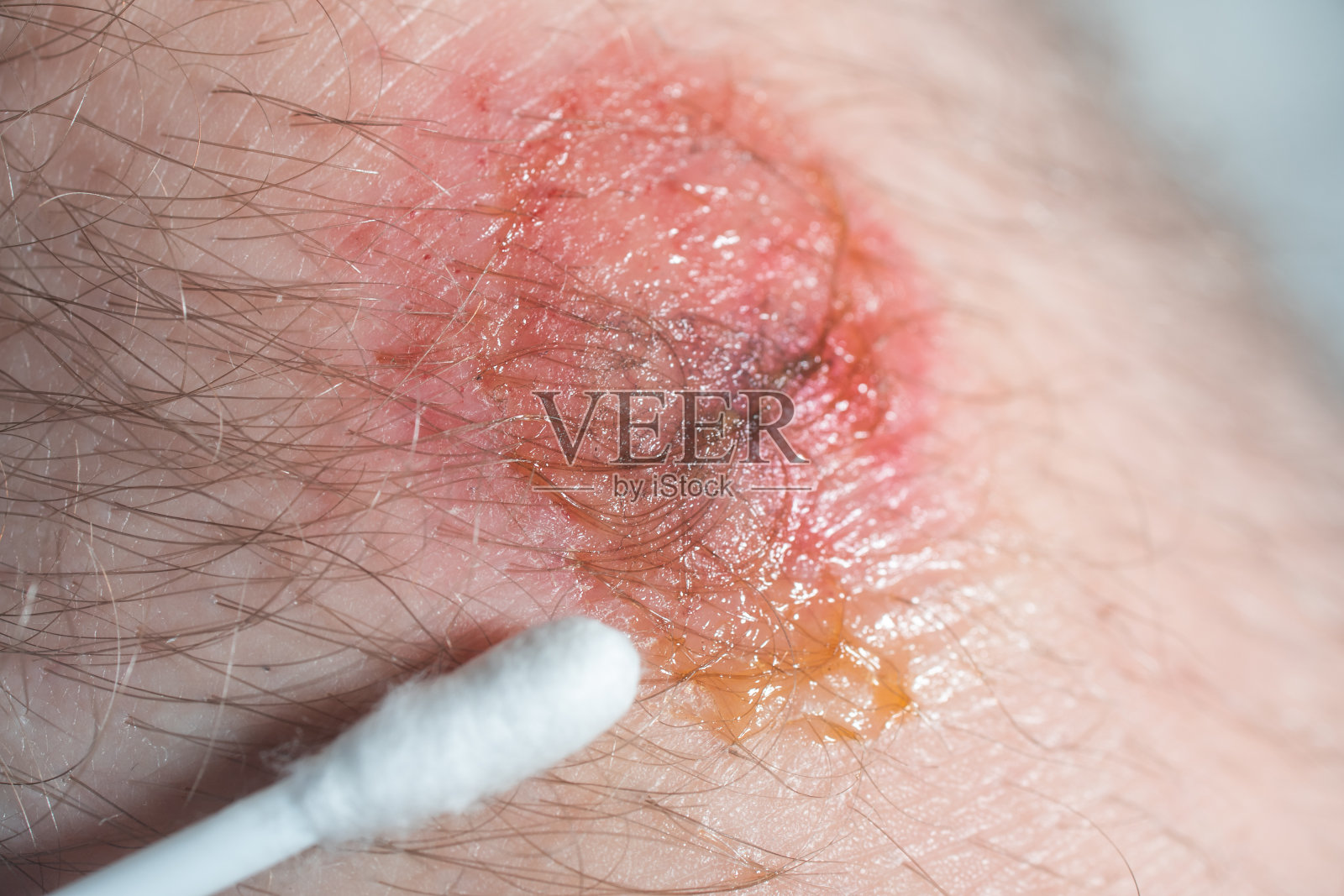 从自行车上摔下来后膝盖受了伤。运动损伤照片摄影图片