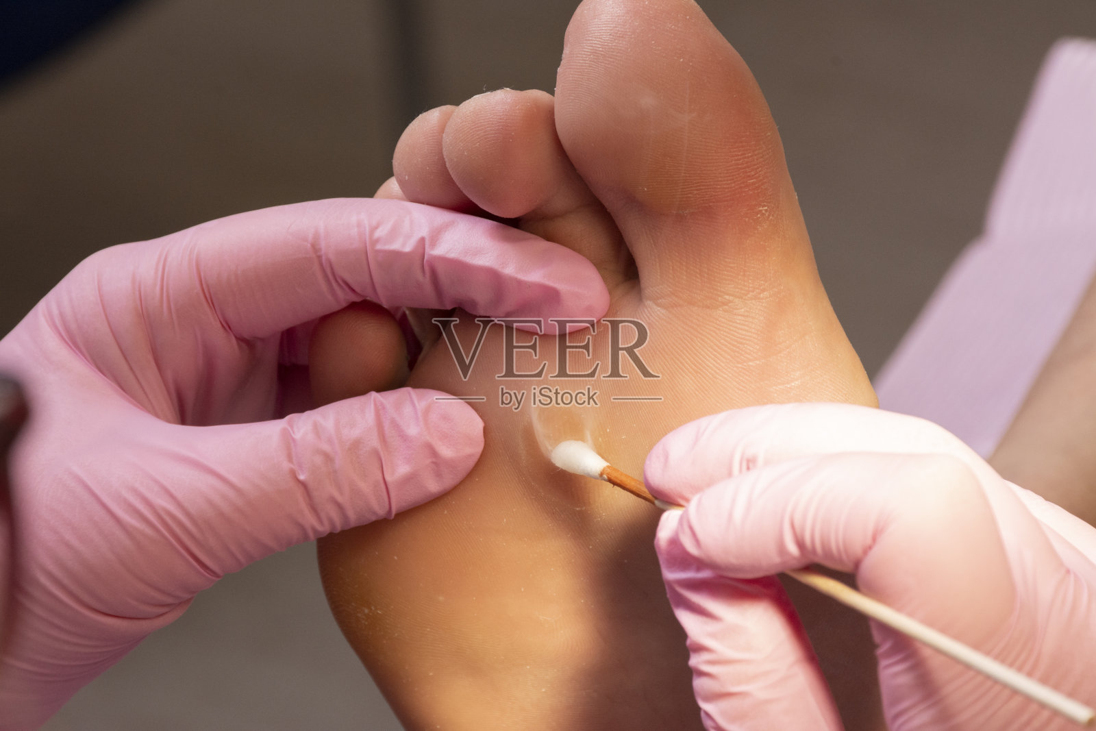 灼烧老茧的伤口照片摄影图片