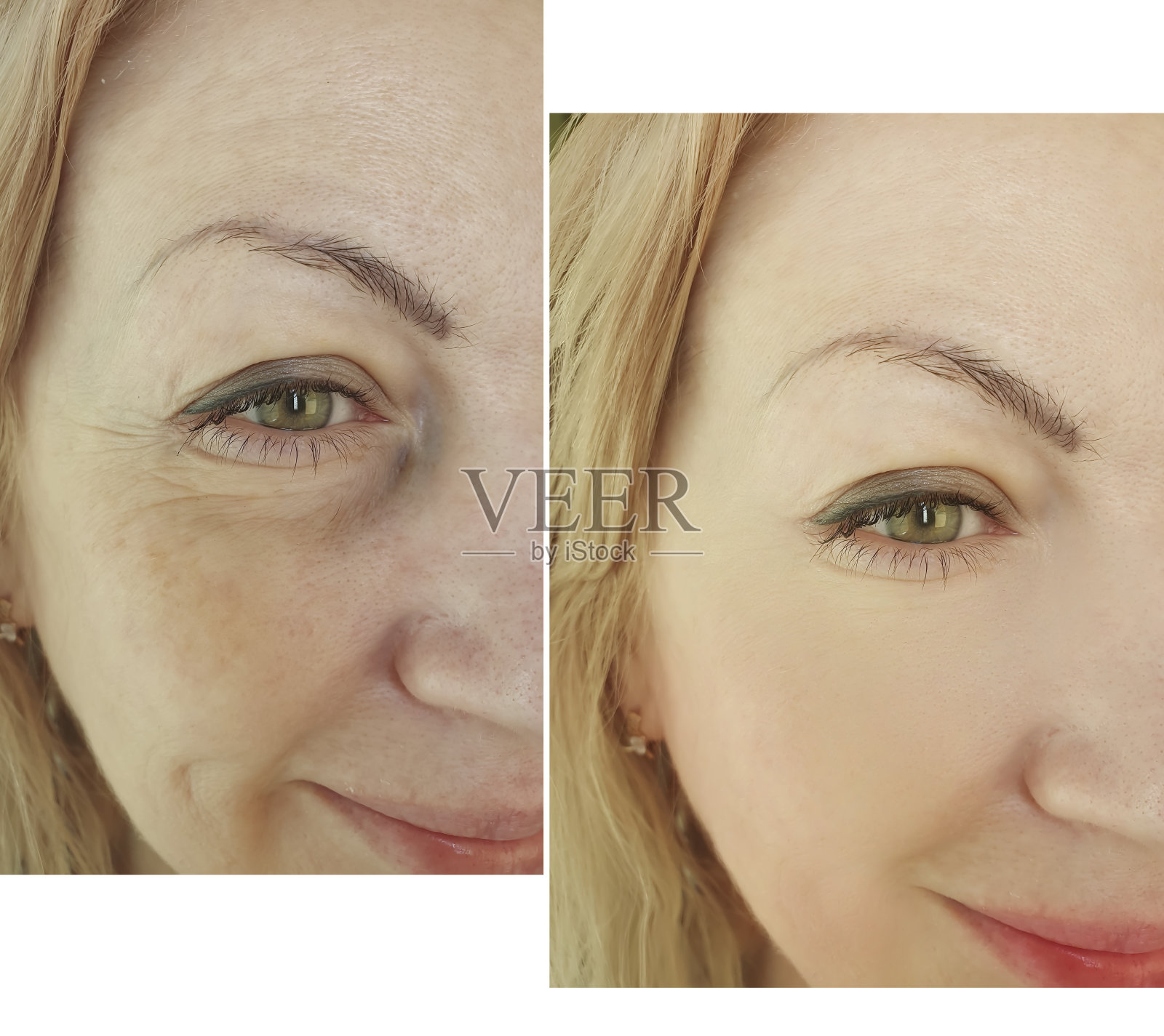 女人脸部皱纹前后拼贴治疗照片摄影图片