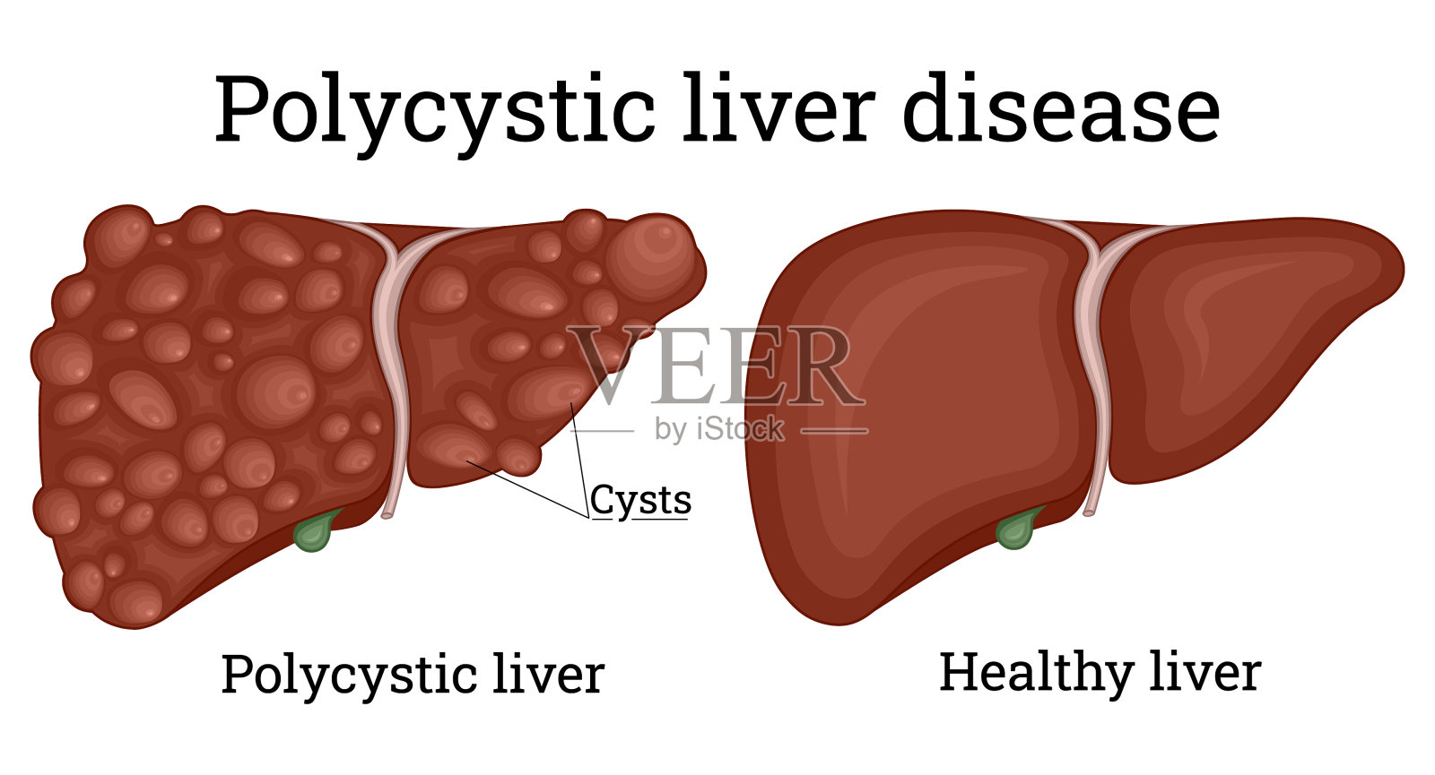多囊性肝病的说明插画图片素材