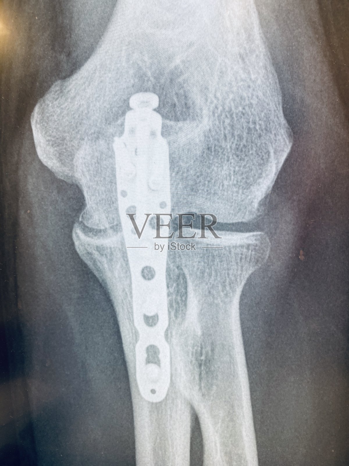 打破ellbow x射线照片摄影图片