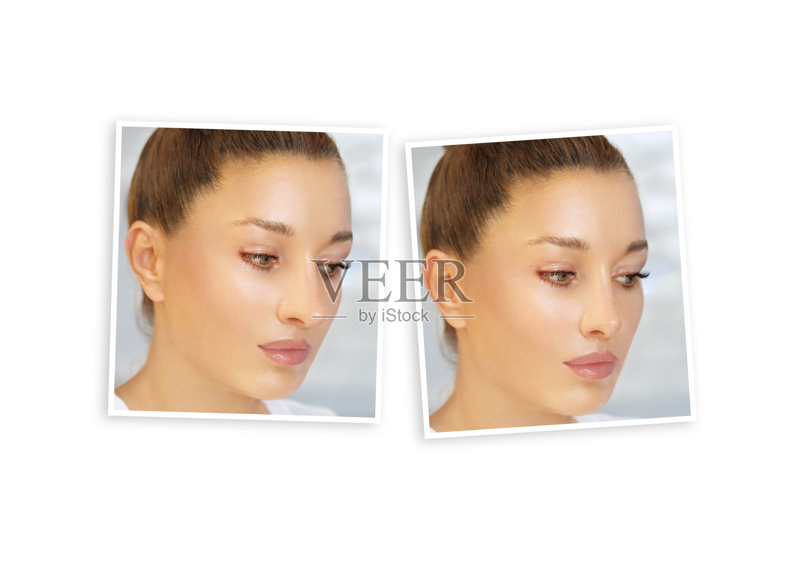 鼻整形术。之前和之后。重建鼻子的过程照片摄影图片